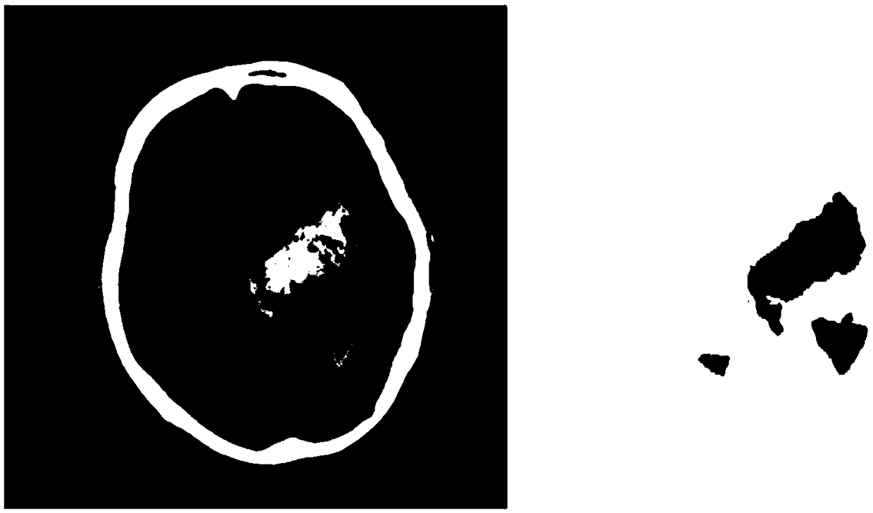 A method of calculating cerebral hemorrhage volume based on depth learning