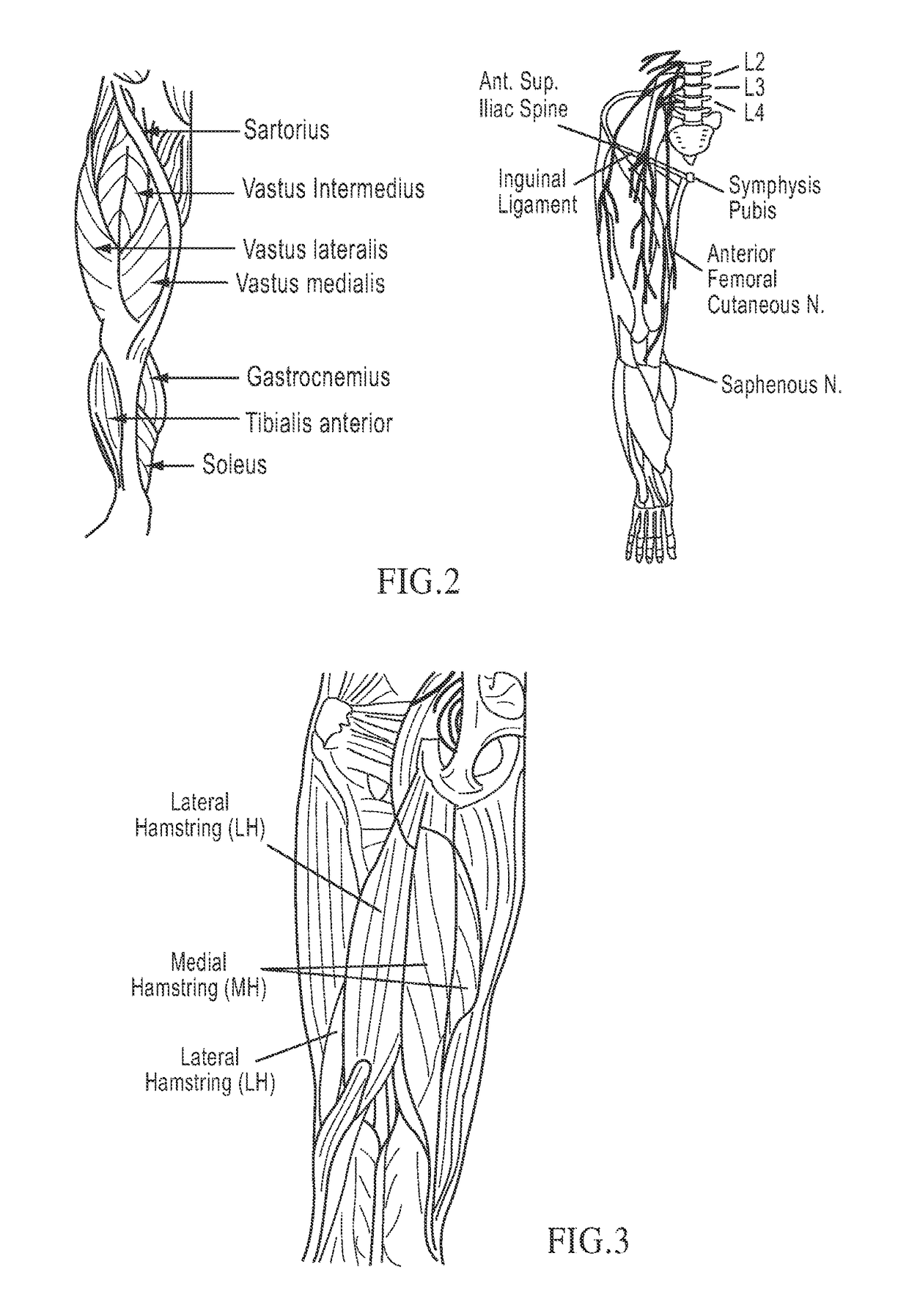 Treatment of indications using electrical stimulation