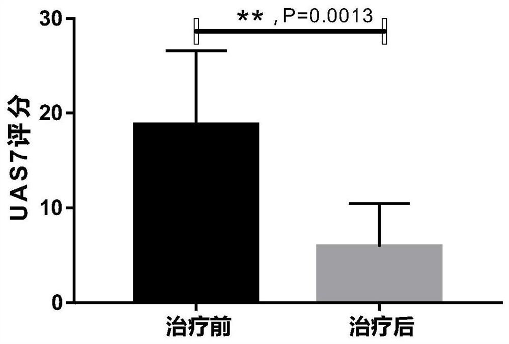 Application of interleukin 2 for treatment of chronic spontaneous urticaria