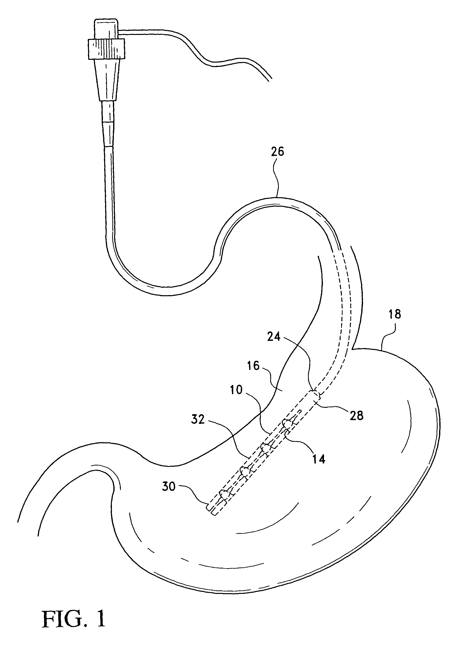 Apparatus for single pass gastric restriction