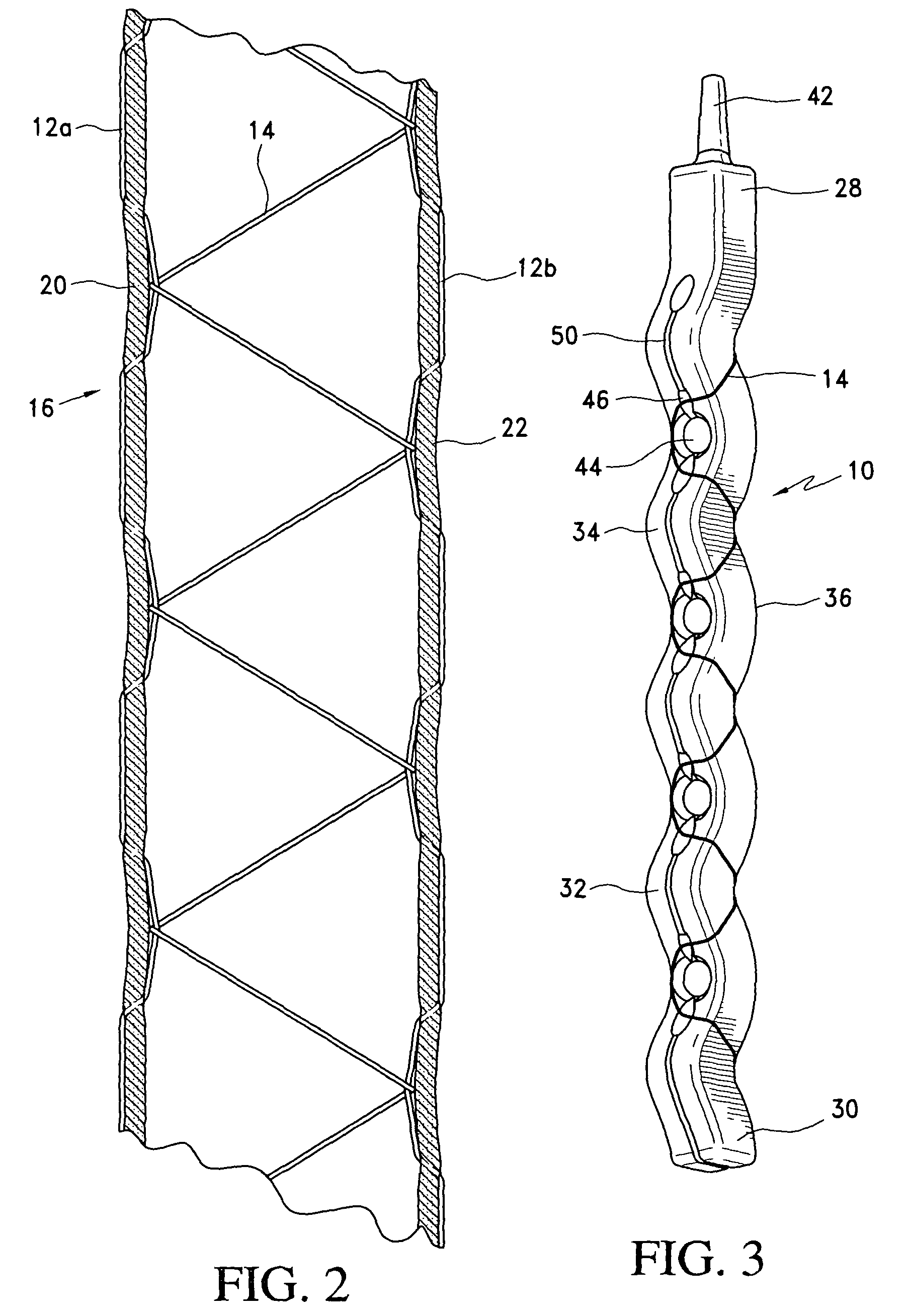 Apparatus for single pass gastric restriction