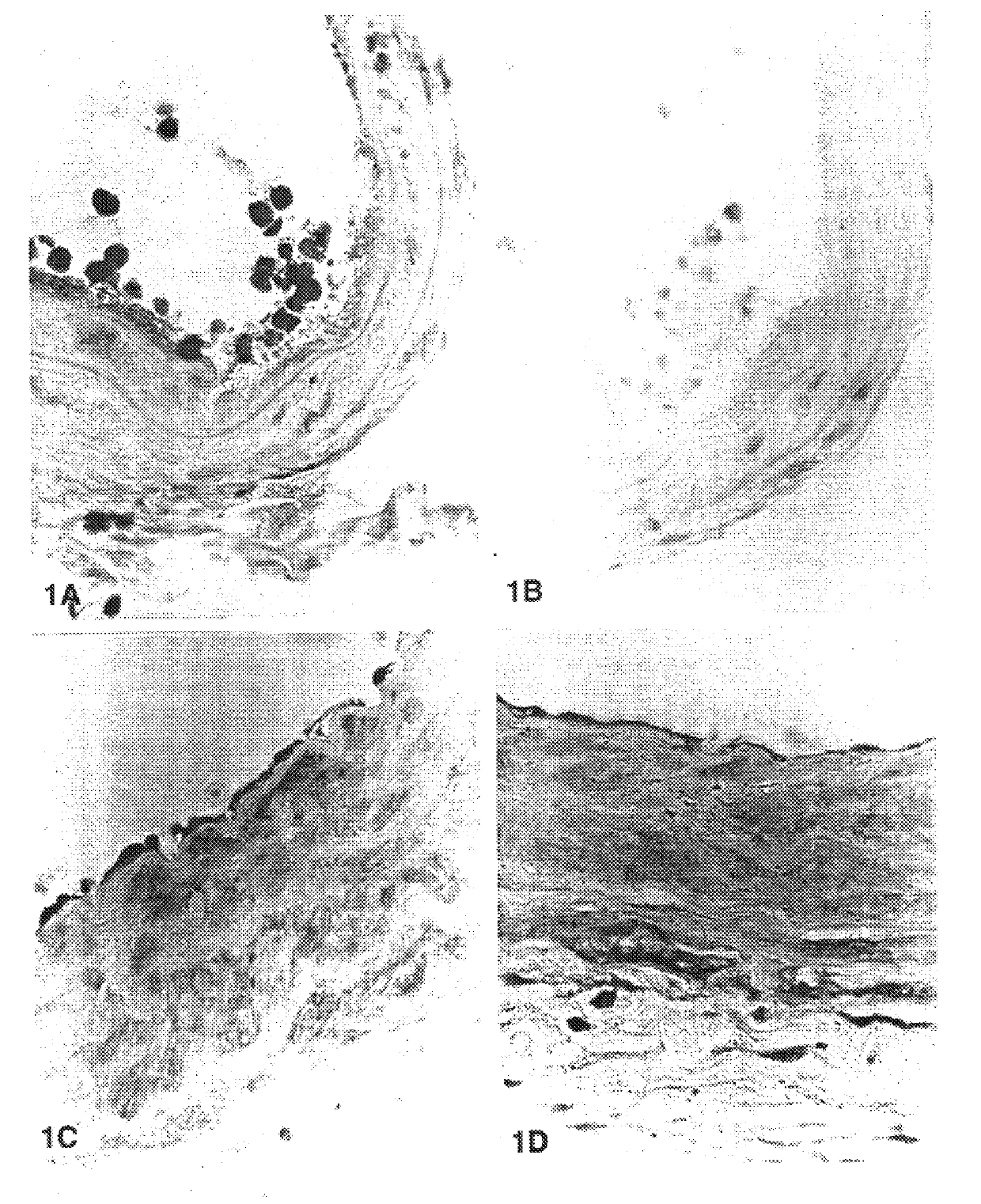 Use of hyaluronic acid and forms to prevent arterial restenosis