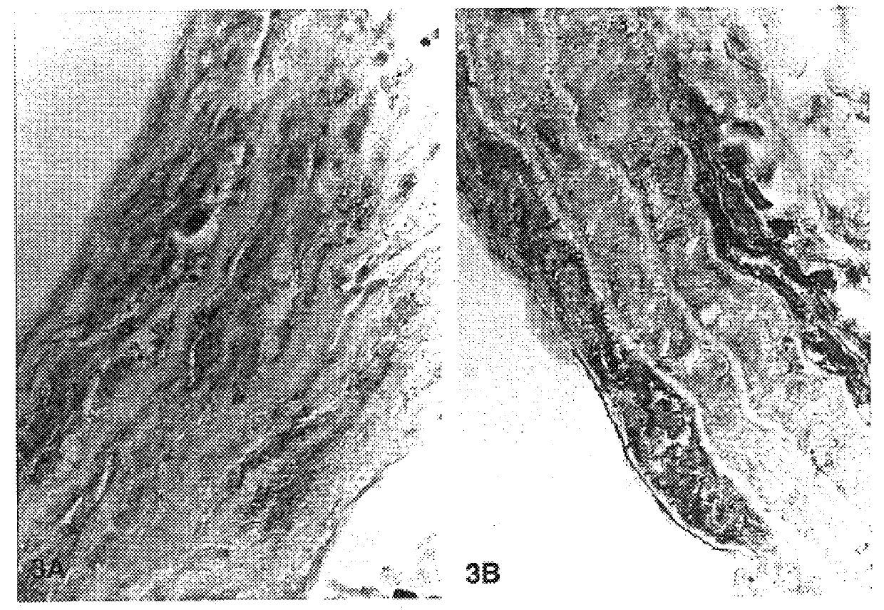 Use of hyaluronic acid and forms to prevent arterial restenosis