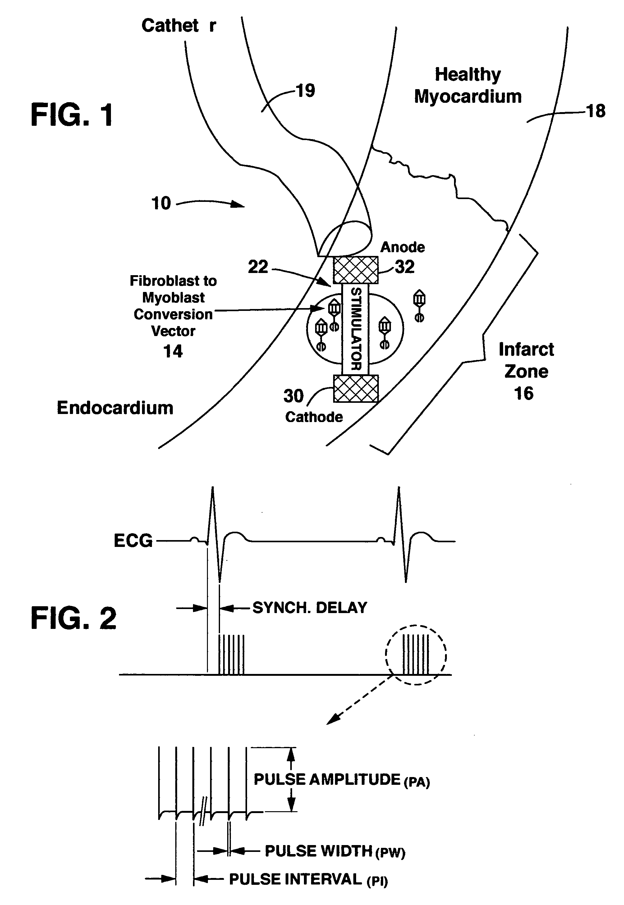 Method and system for myocardial infarction repair