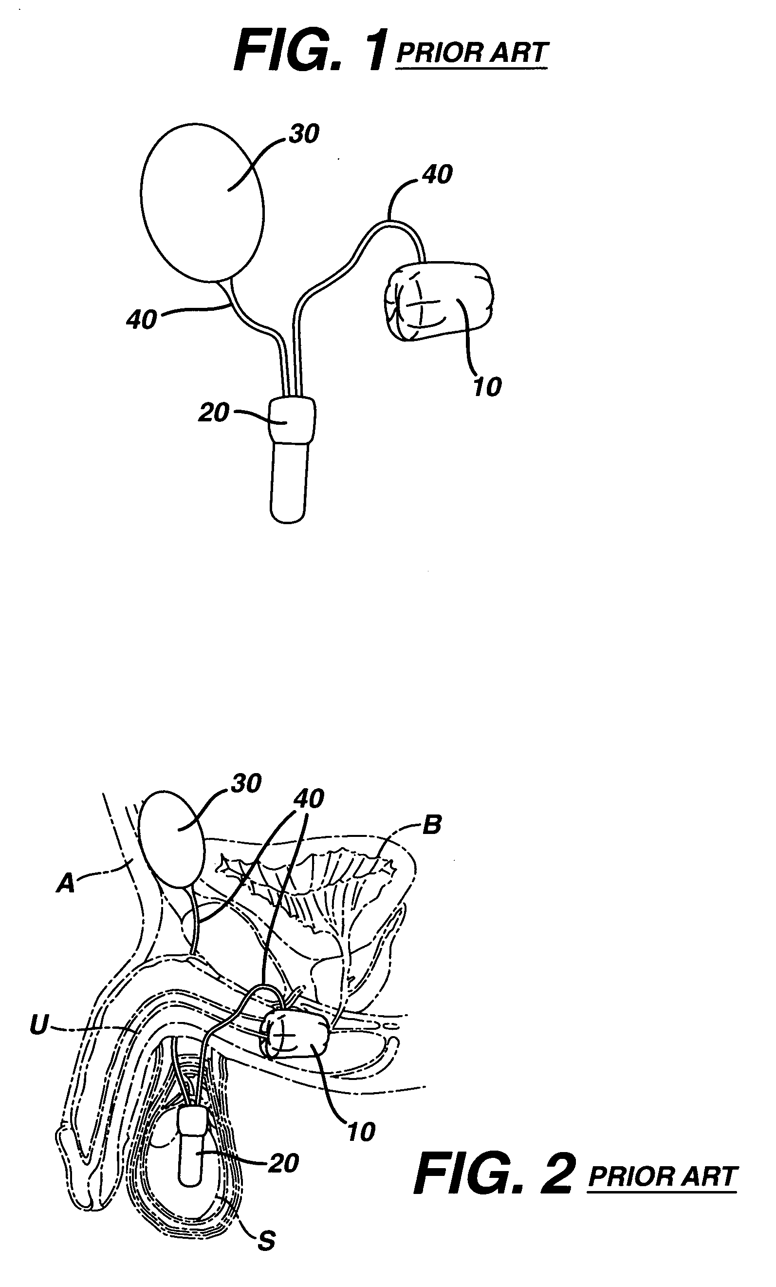 Artificial sphincter with variable viscosity fluid-filled collar