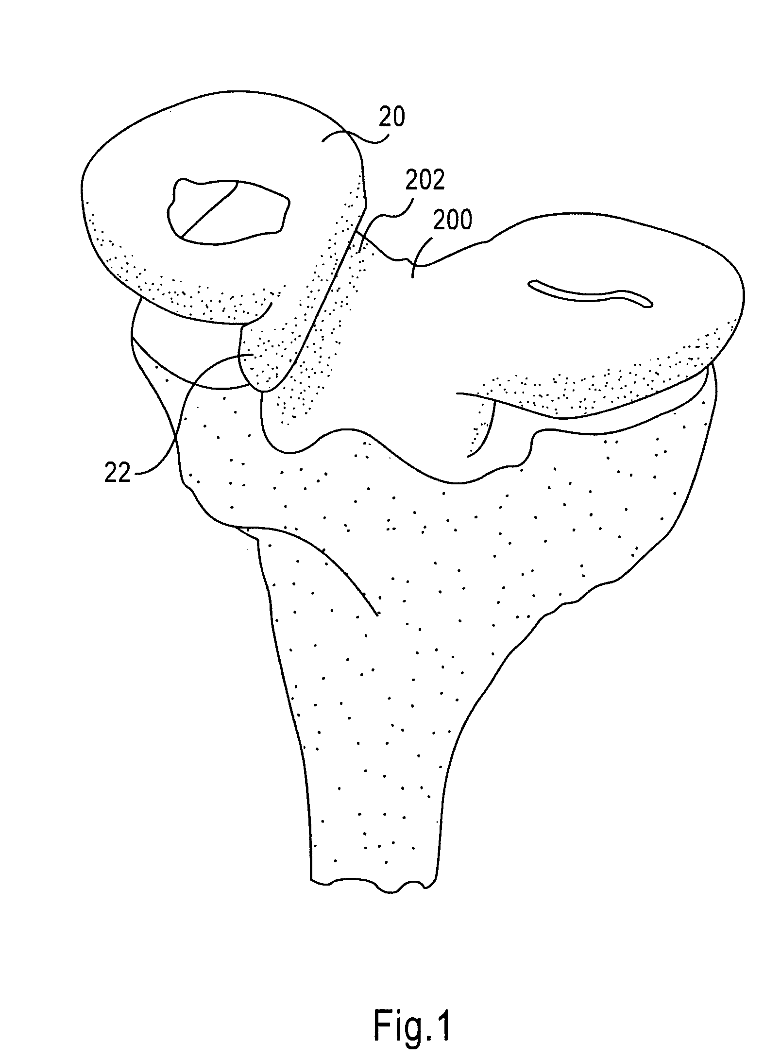 Instrumentation and method for repair of meniscus tissue