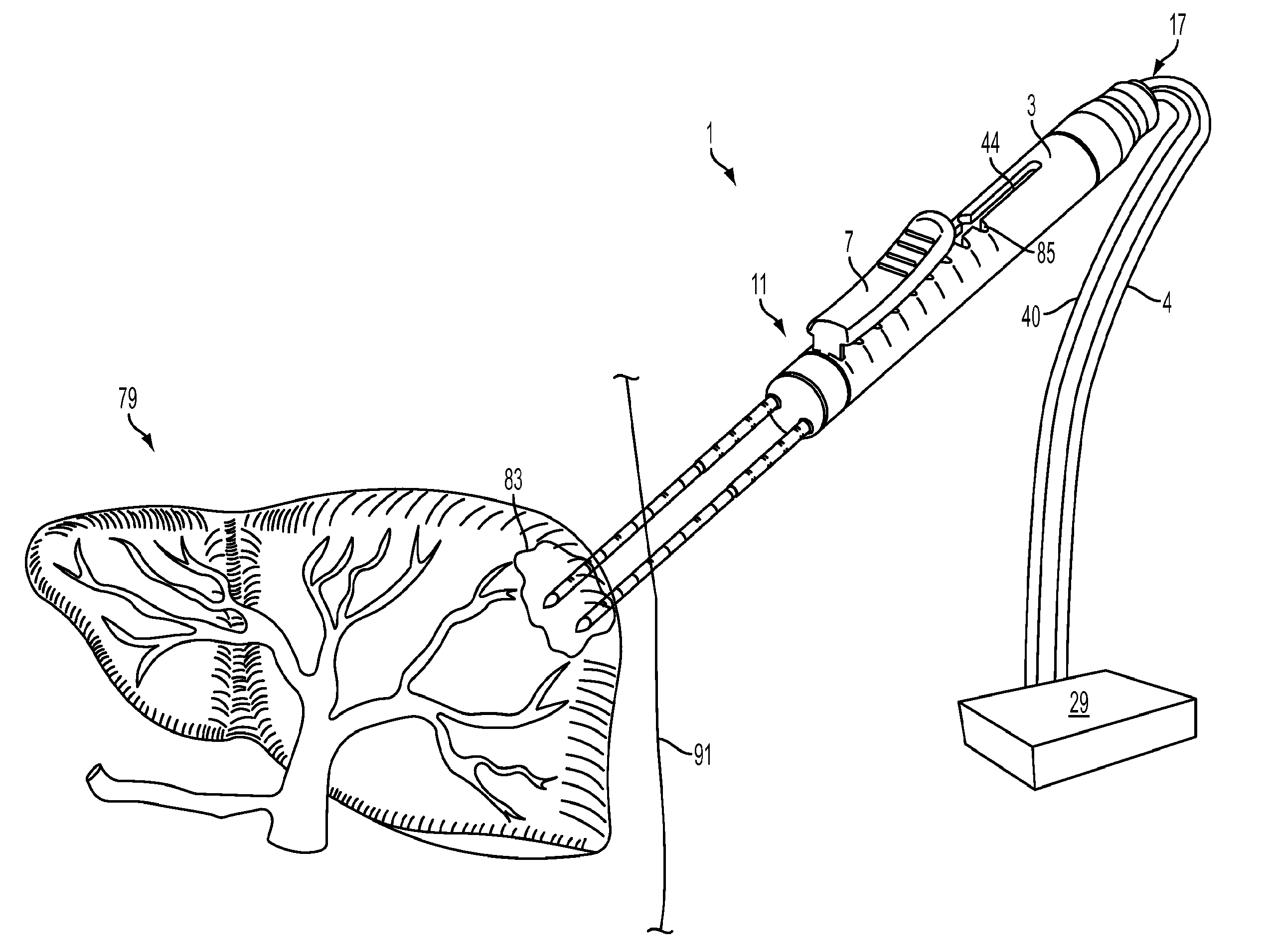 Multiple Treatment Zone Ablation Probe