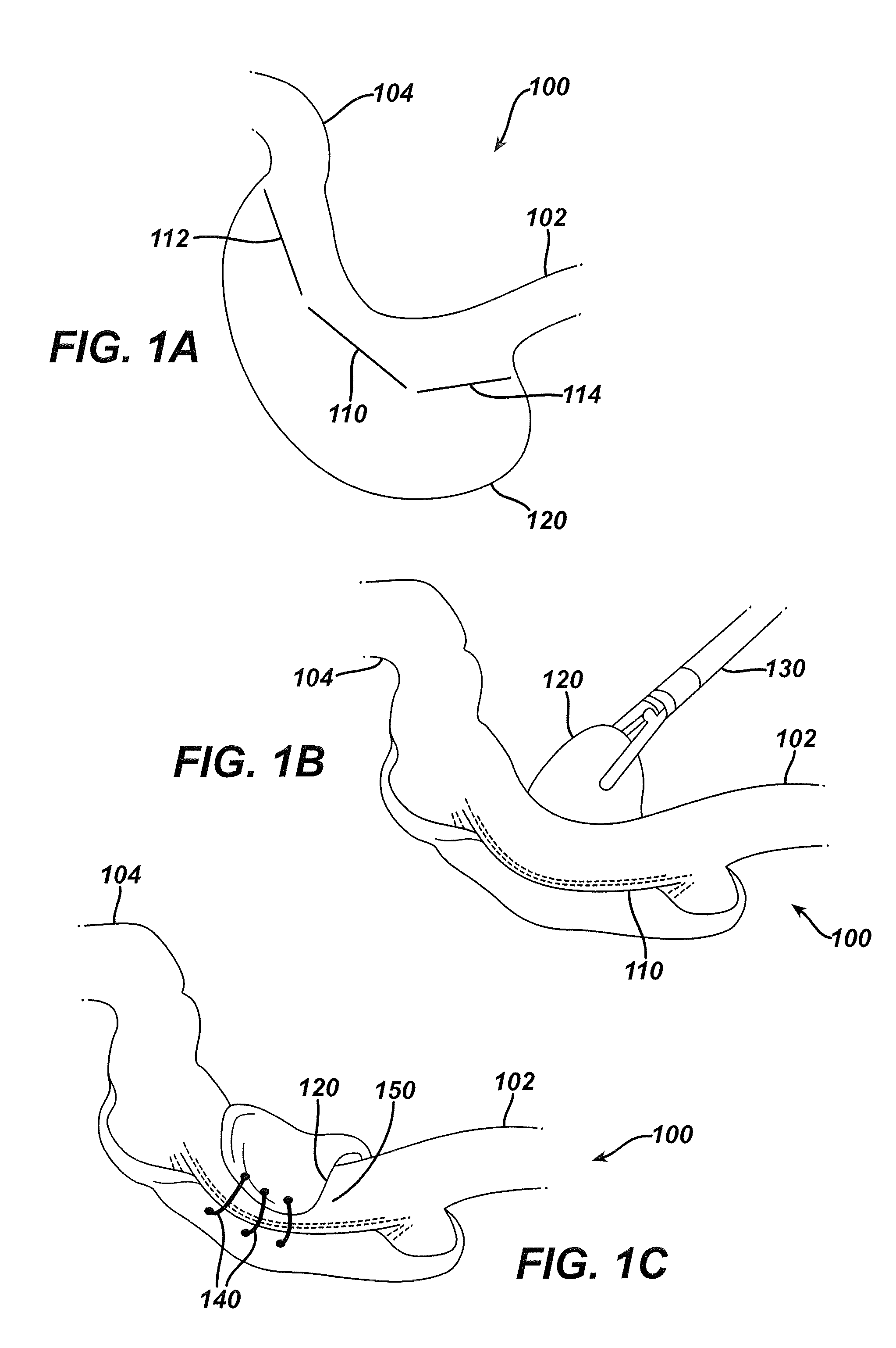 Systems and methods for gastric volume regulation