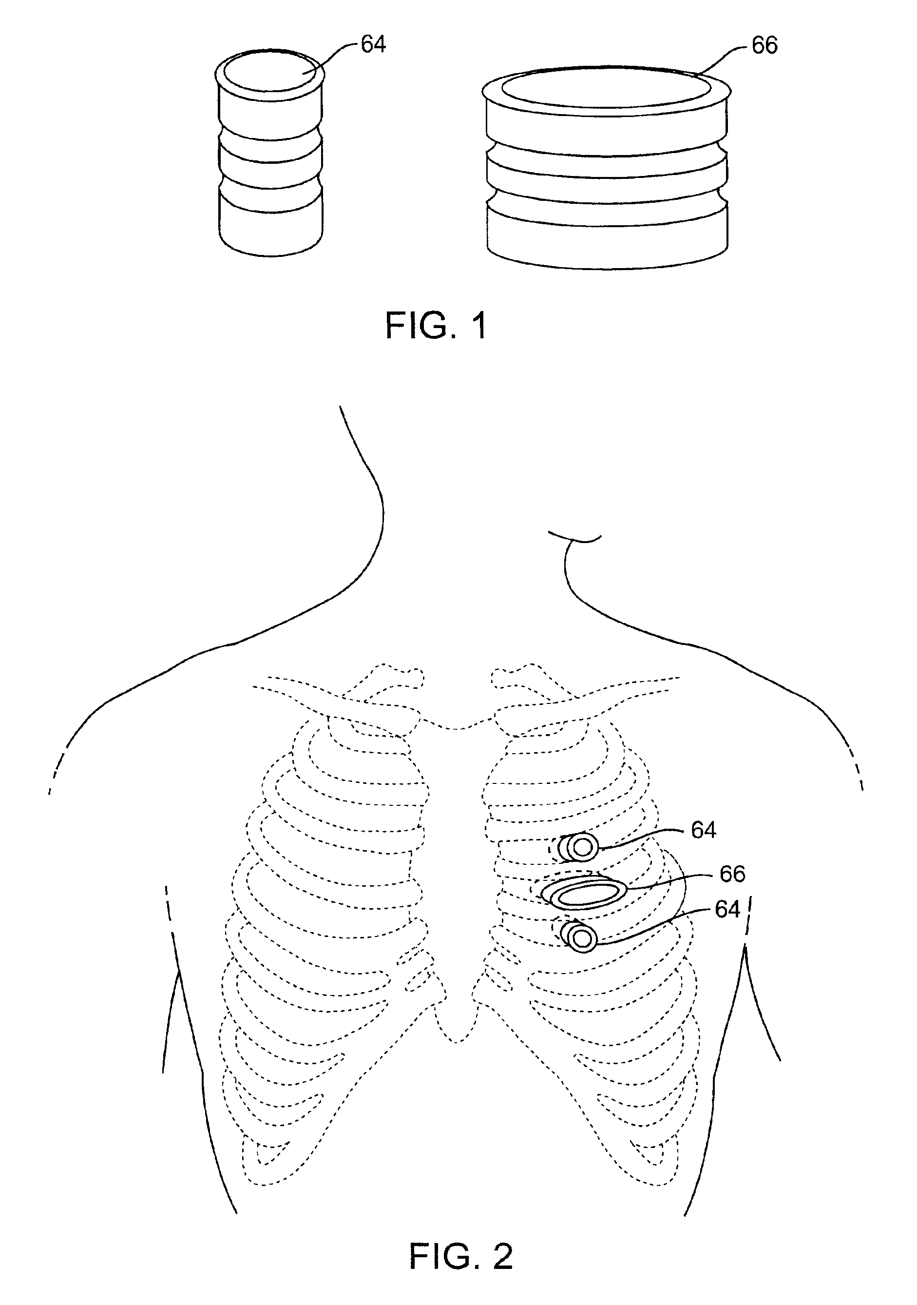 Method and system for performing closed-chest bypass