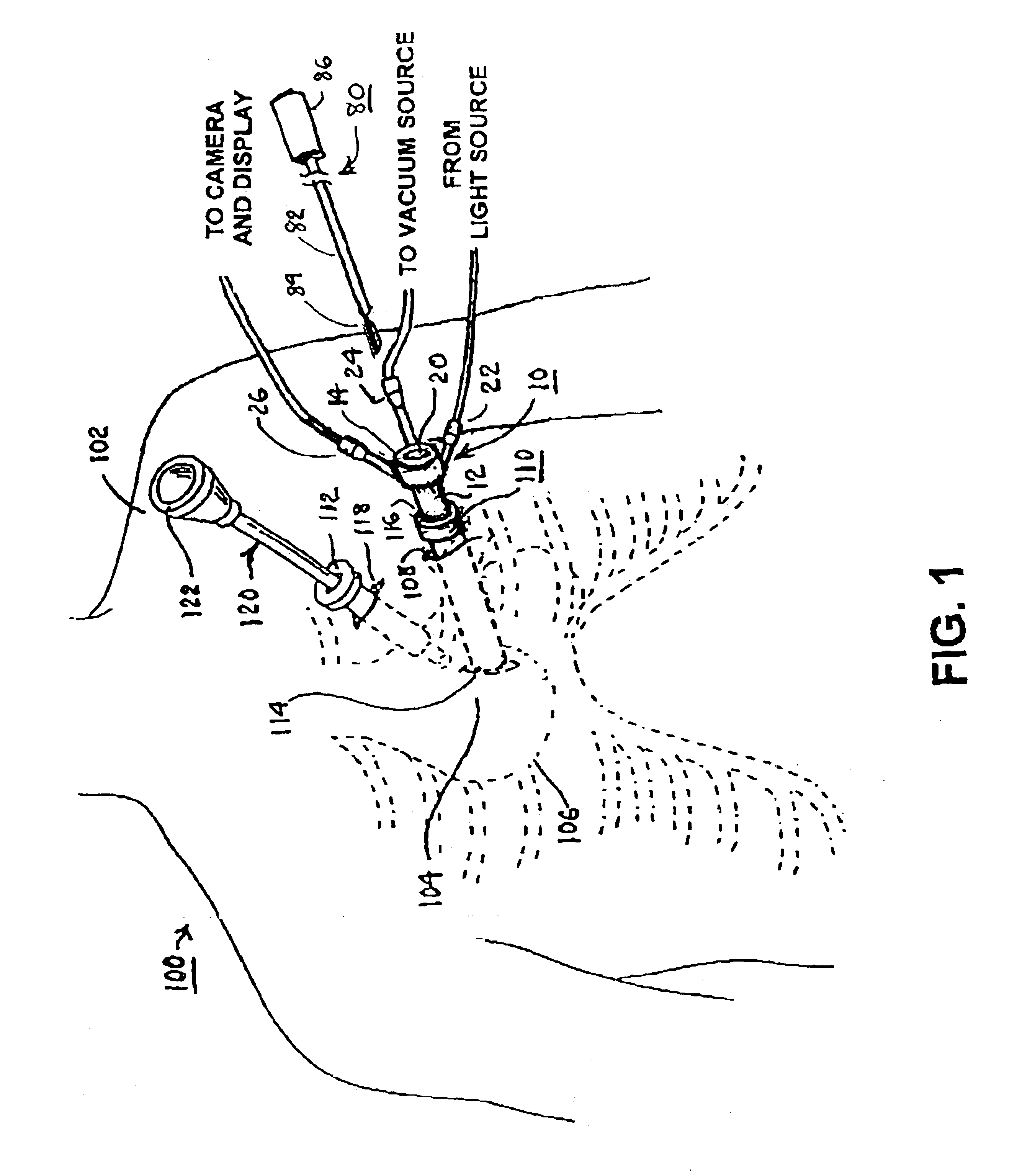 Methods and apparatus for accessing and stabilizing an area of the heart