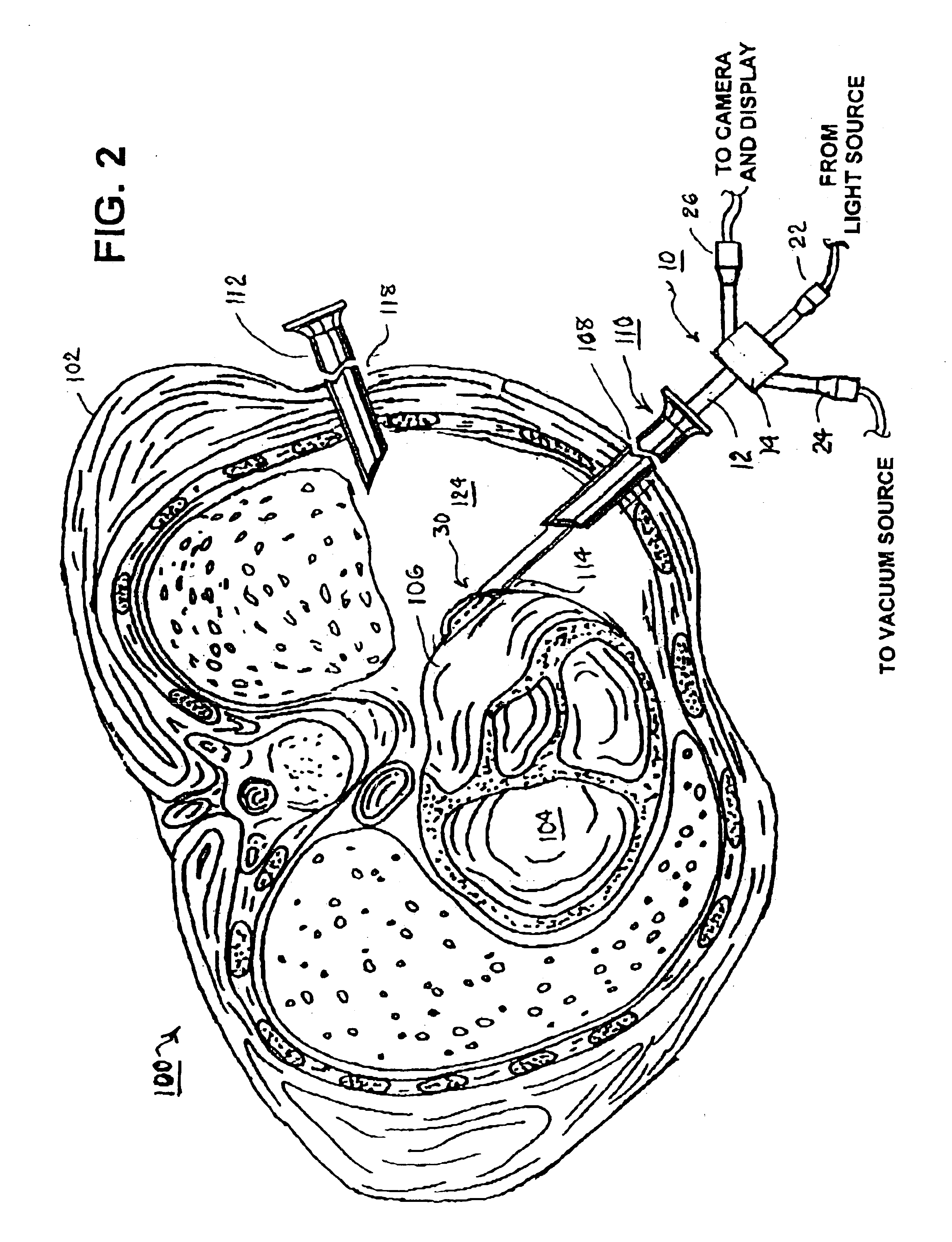 Methods and apparatus for accessing and stabilizing an area of the heart