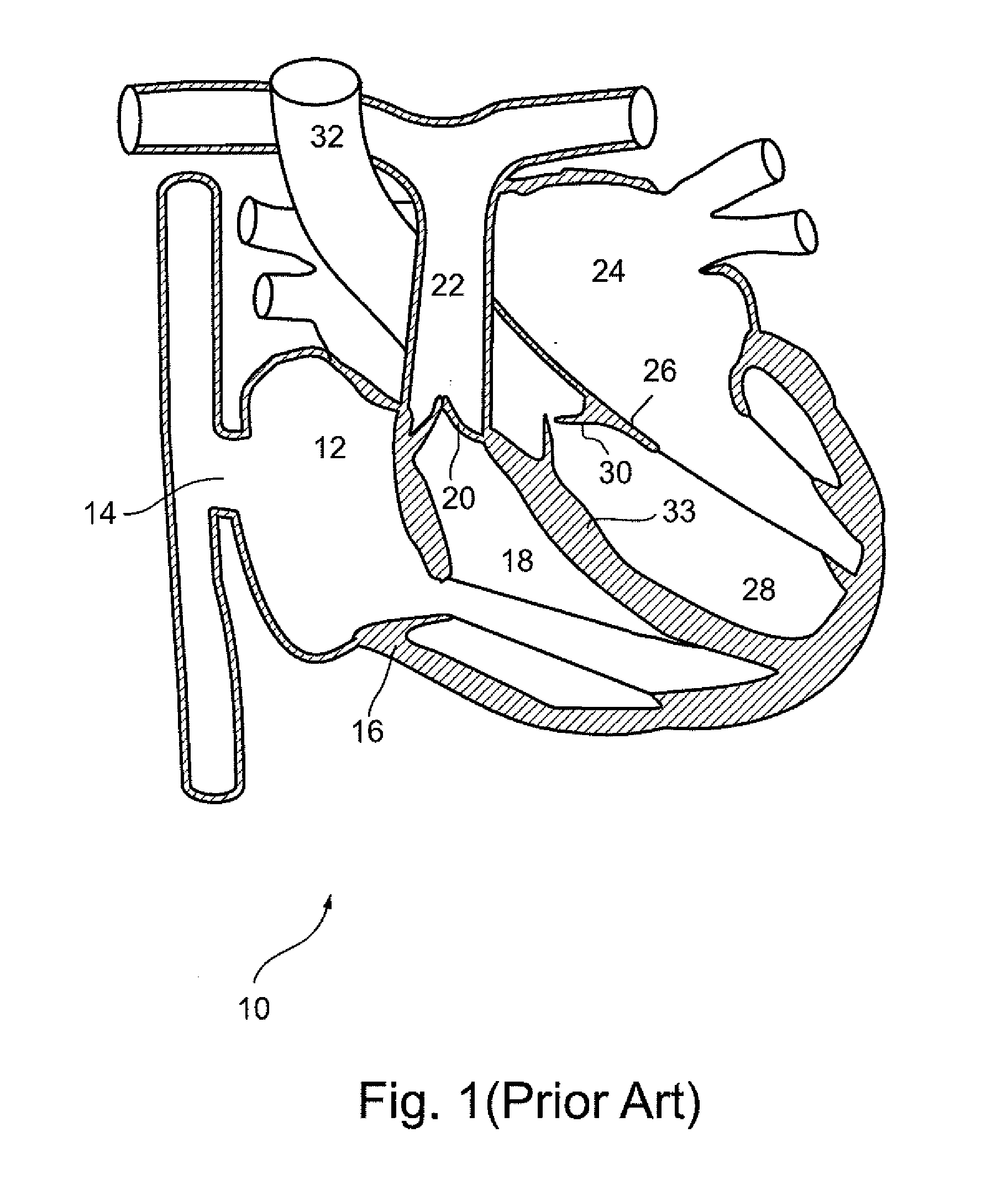 Cardiac valve leaflet augmentation