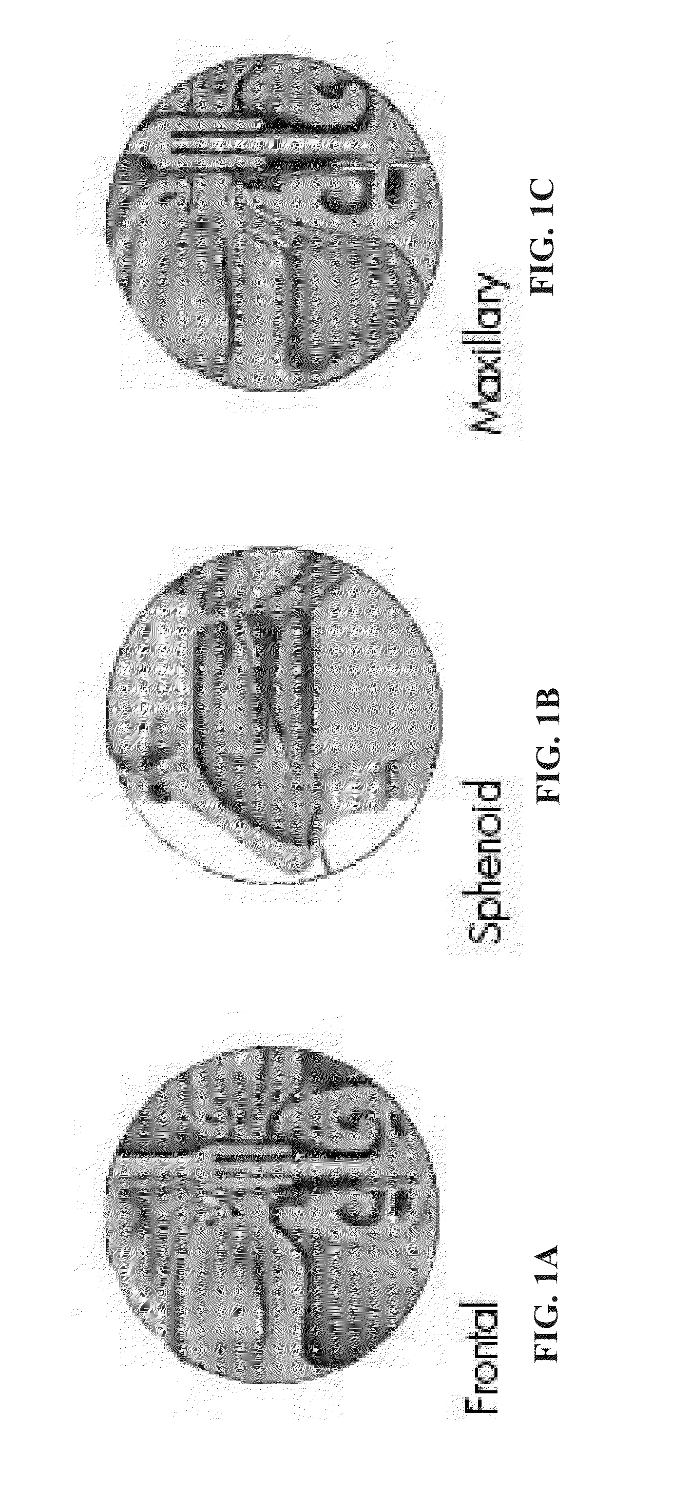 Transplantation of cells into the nasal cavity and the subarachnoid cranial space