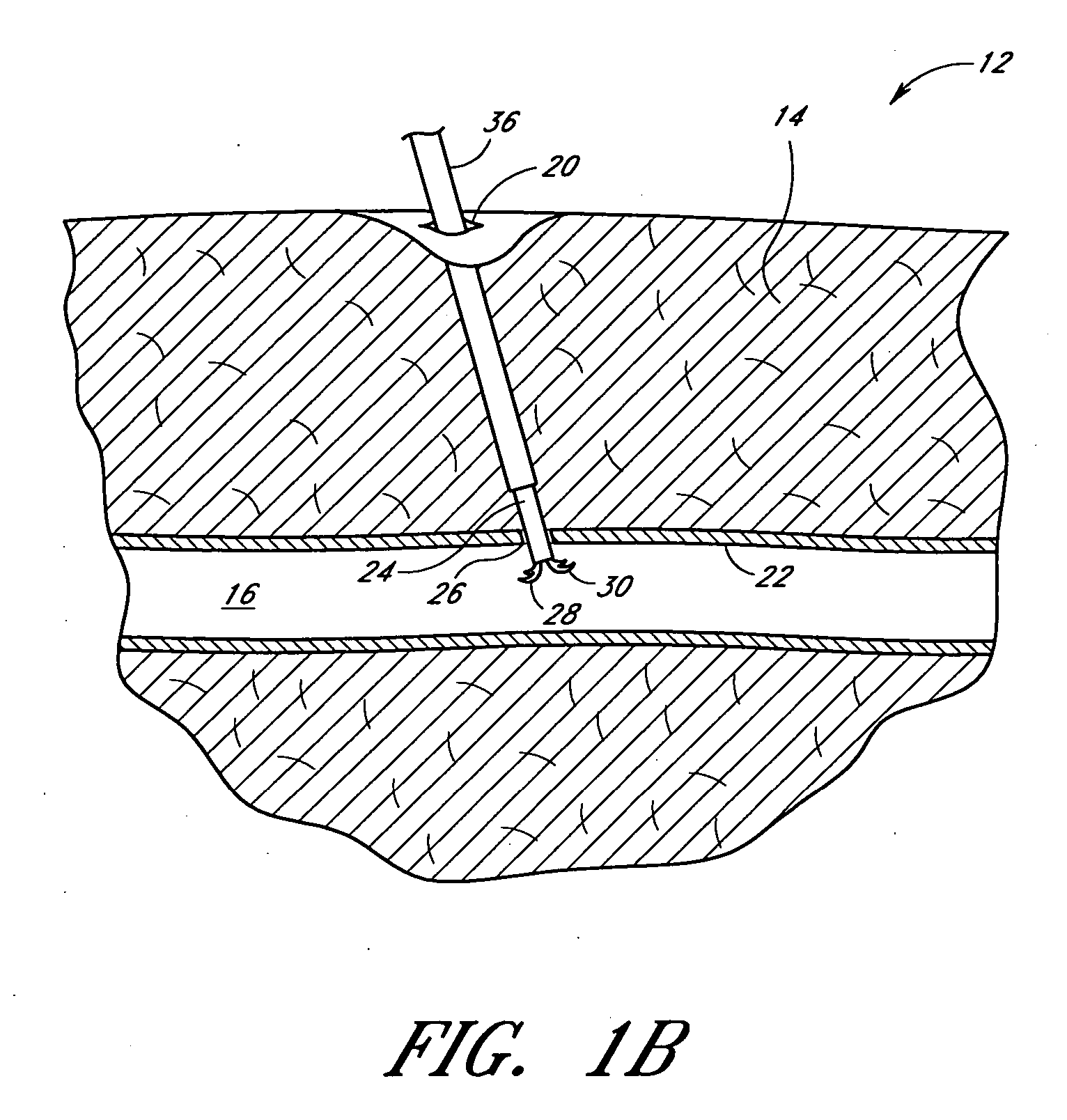 Suturing device and method