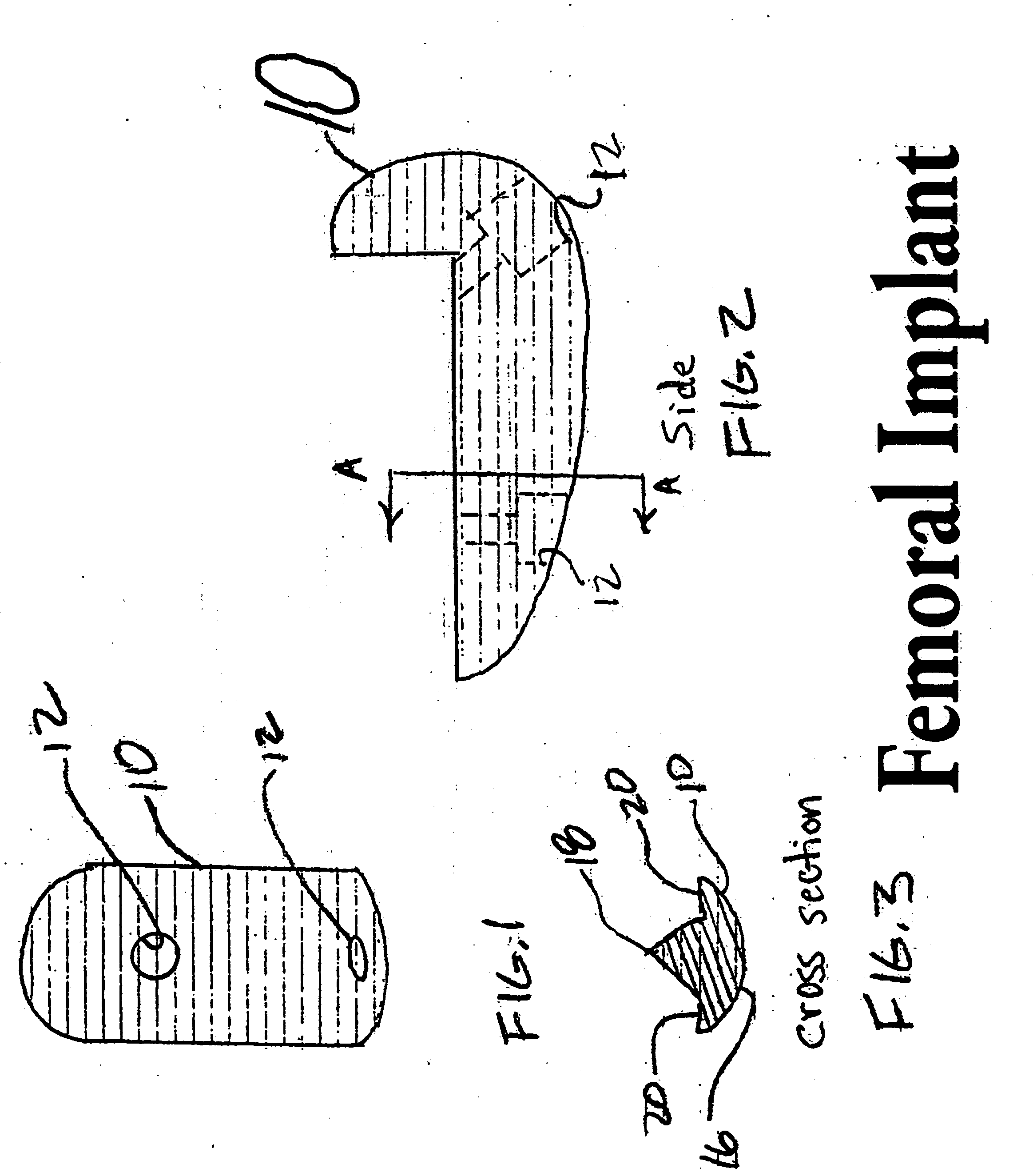 Device and method of arthroscopic knee joint resurfacing