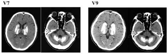 Human PFBC pathogenic gene MYORG with mutation at 1328th locus and application of human PFBC pathogenic gene MYORG