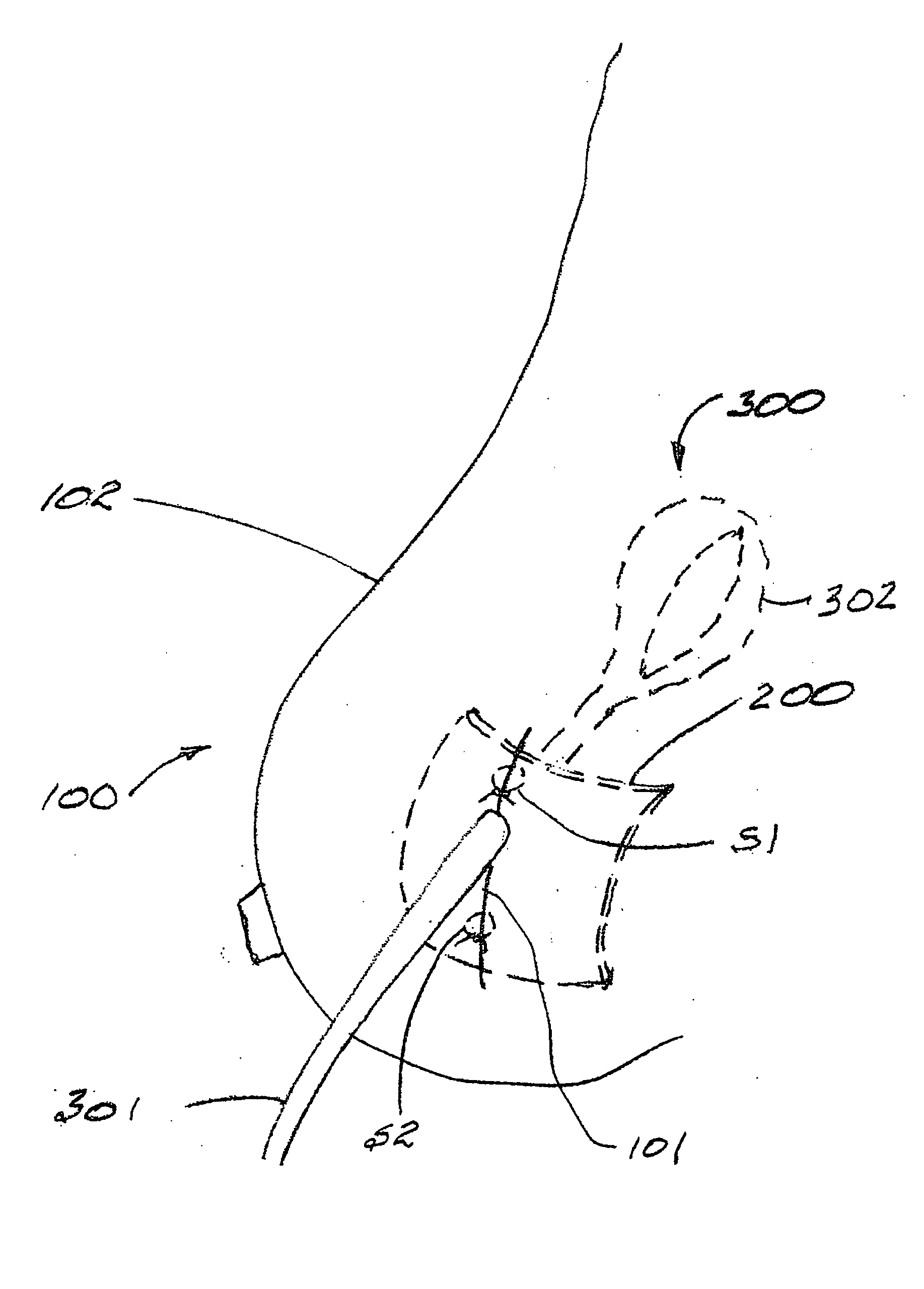 Radiation blocking patch for radio-therapy