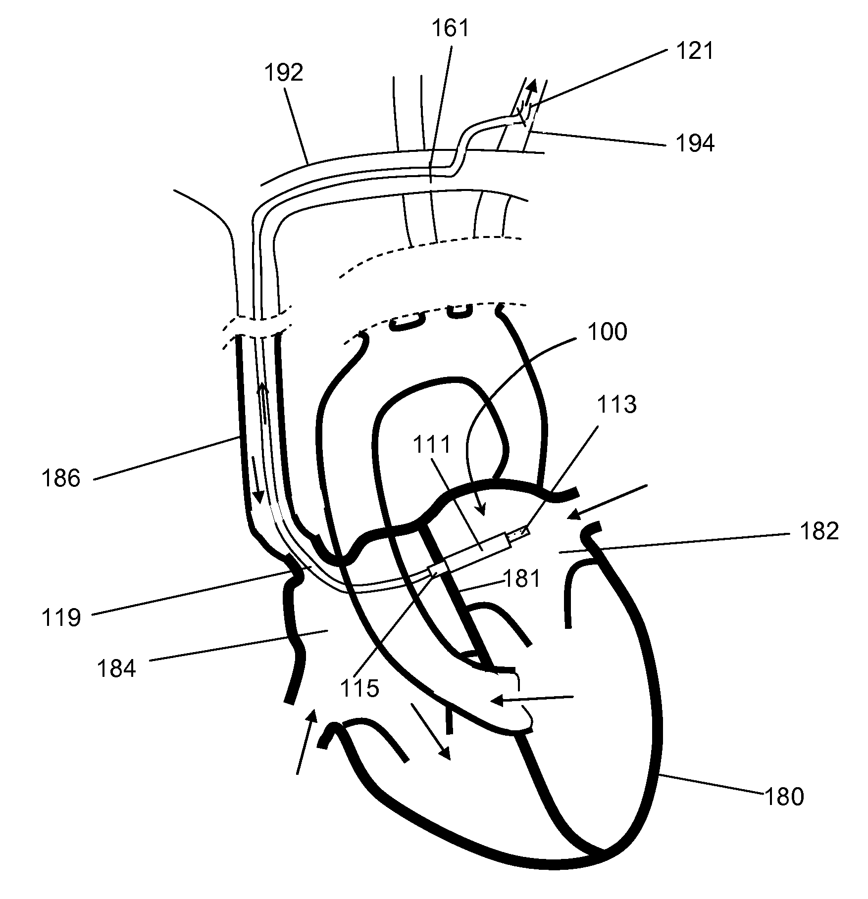 Intraatrial ventricular assist device