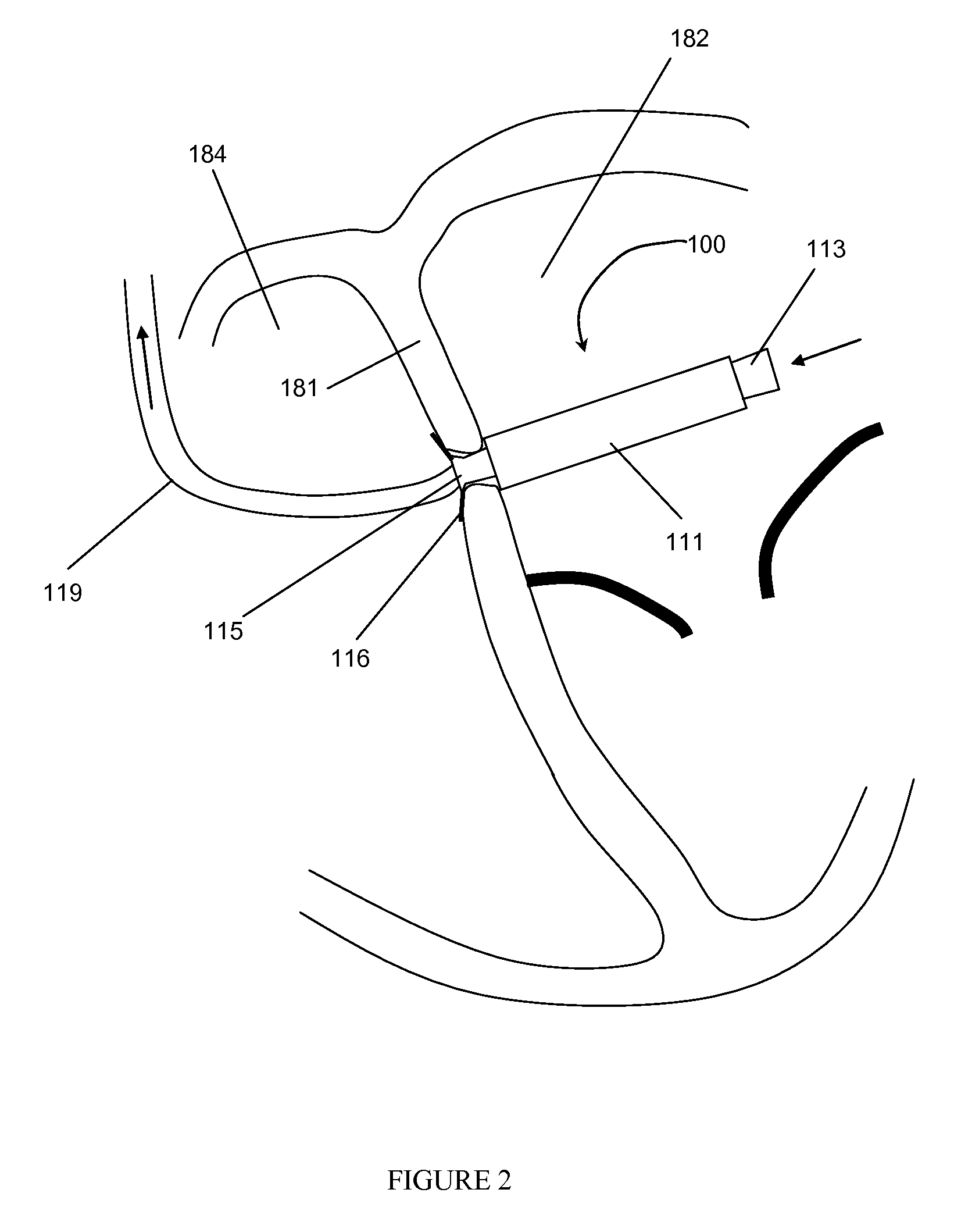 Intraatrial ventricular assist device