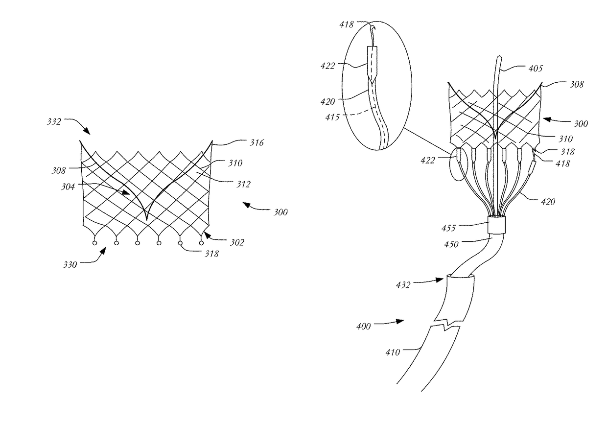 Transapical mitral valve replacement