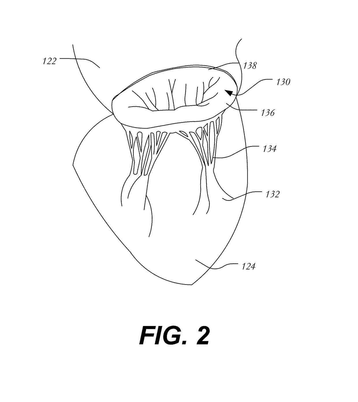 Transapical mitral valve replacement