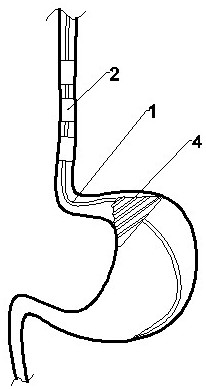 A multi-lumen multi-cystic tube capable of fixed-point hemostasis