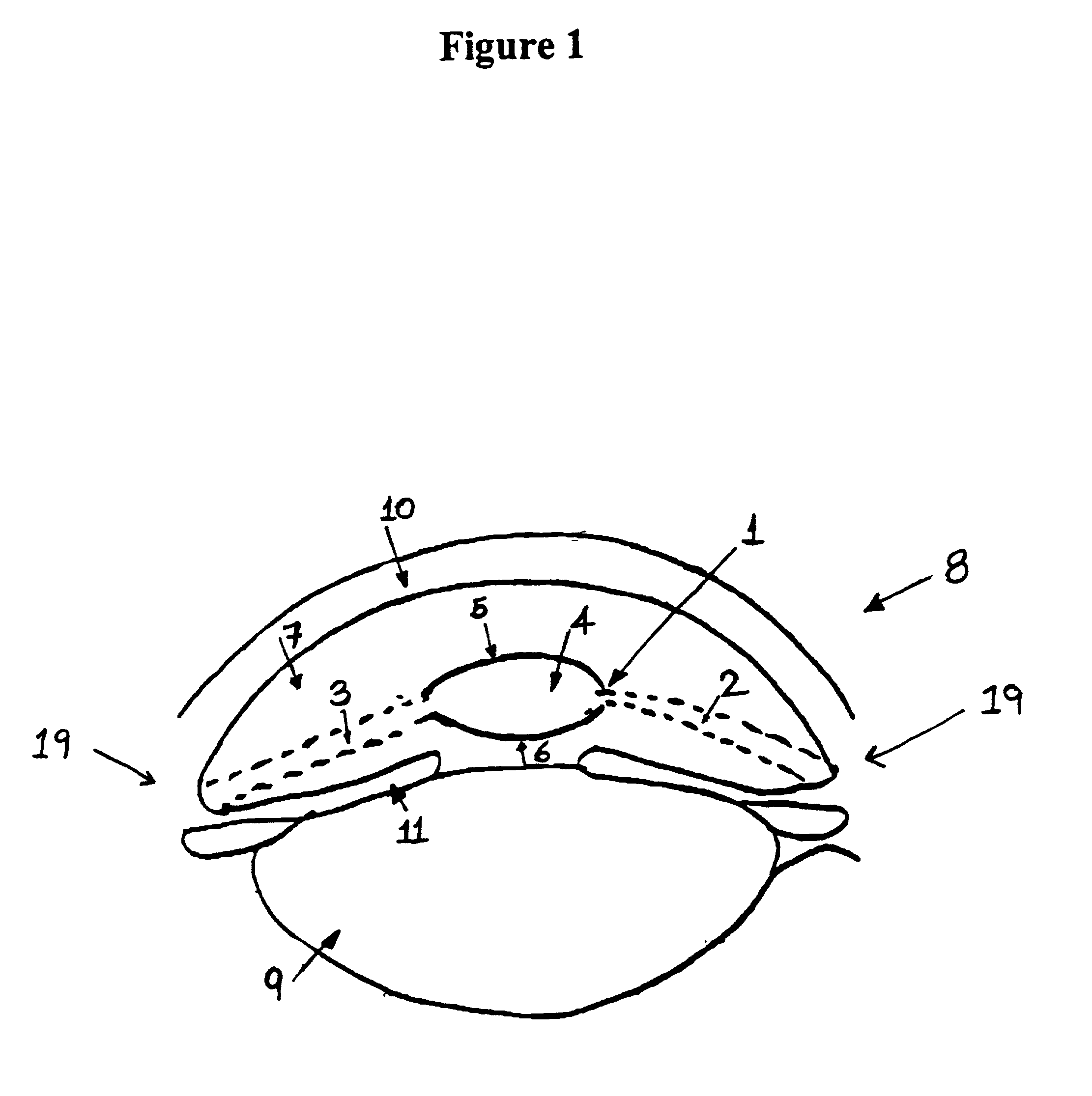 Positive power anterior chamber ocular implant