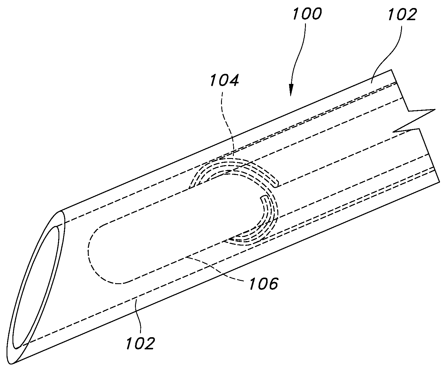 Expandable dialysis apparatus and method