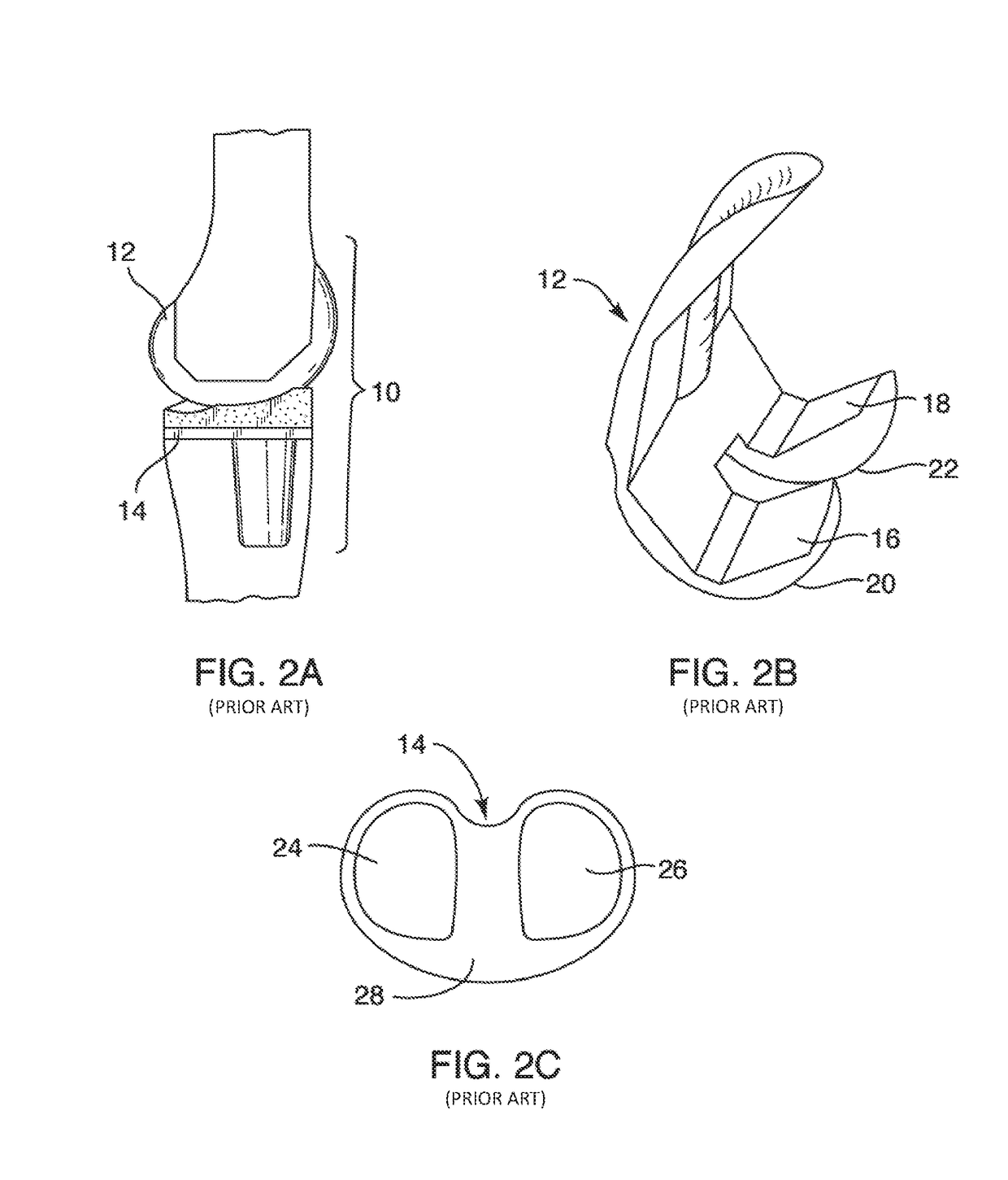 Systems and methods for providing prosthetic components