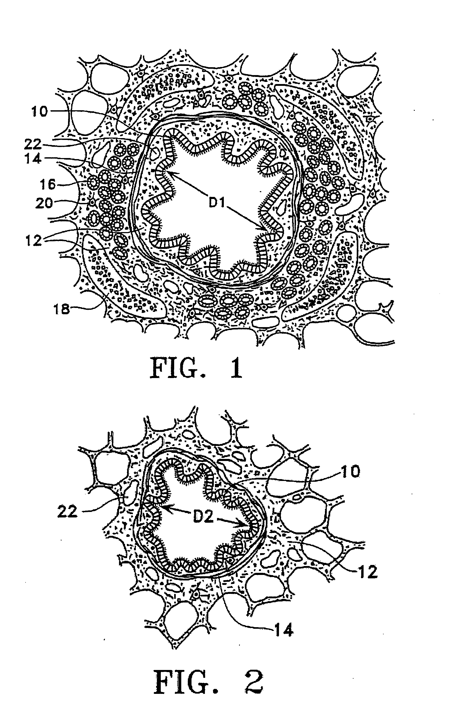 Methods for treating airways