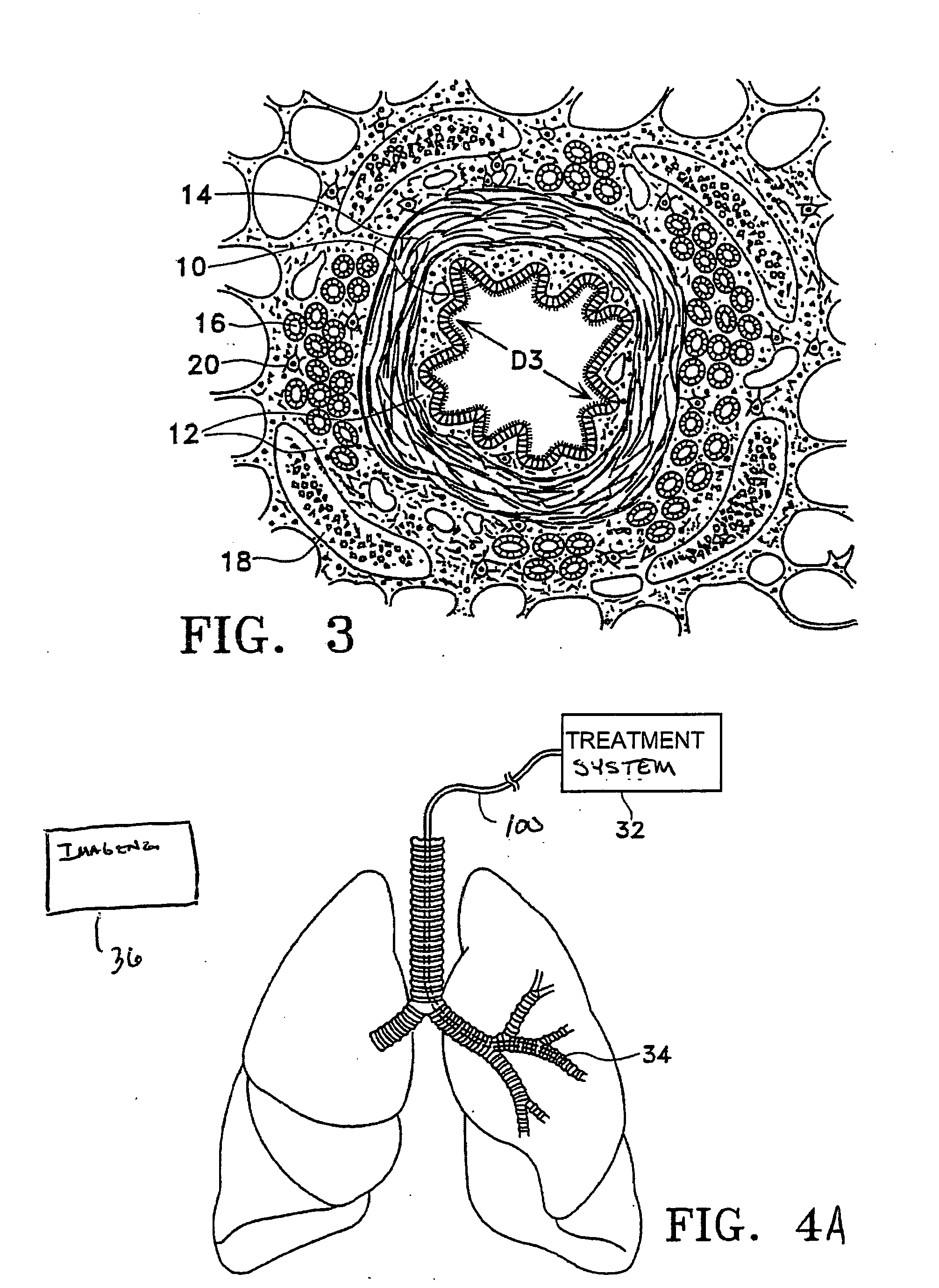 Methods for treating airways