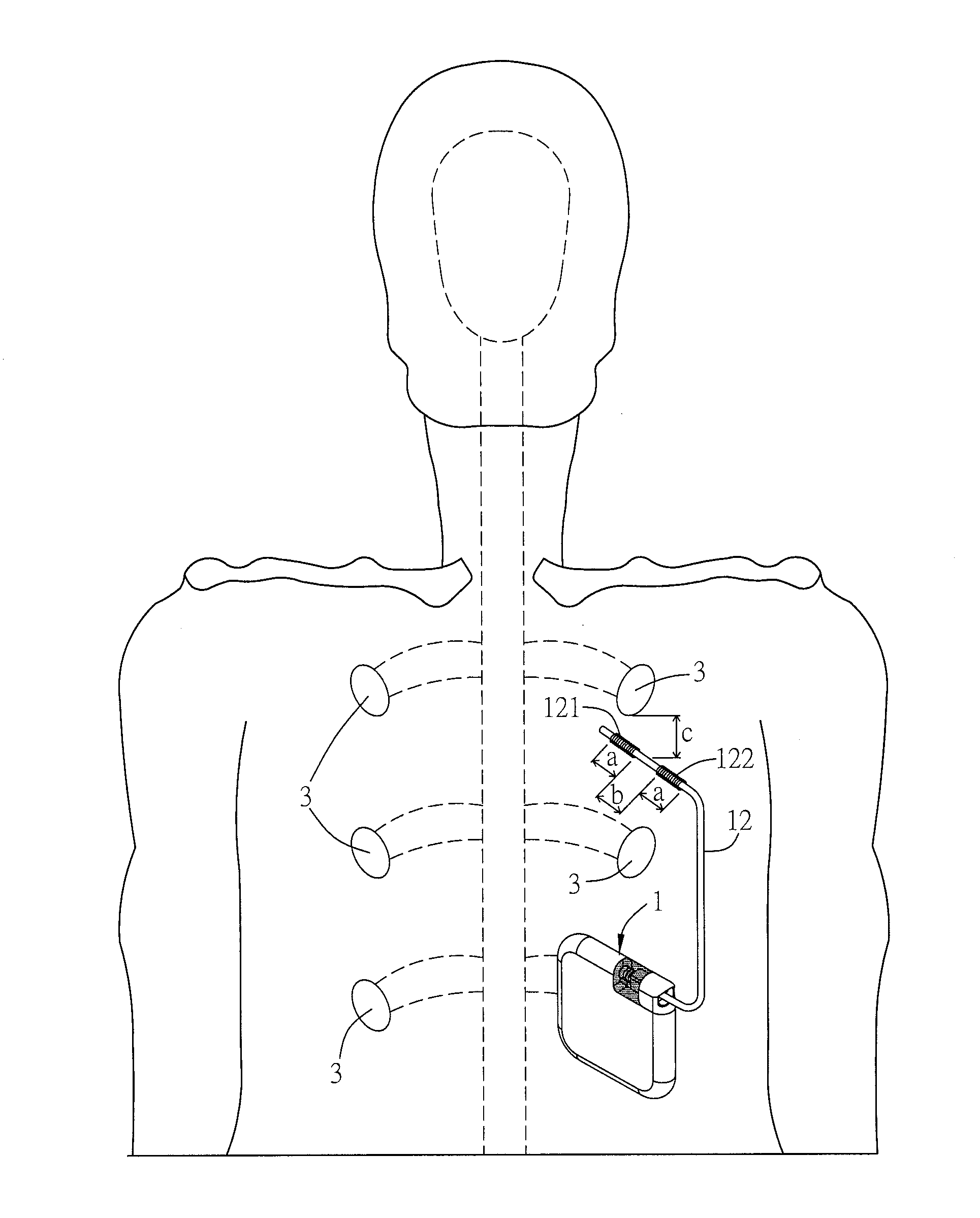 Method of reducing renal hypertension and computer-readable medium