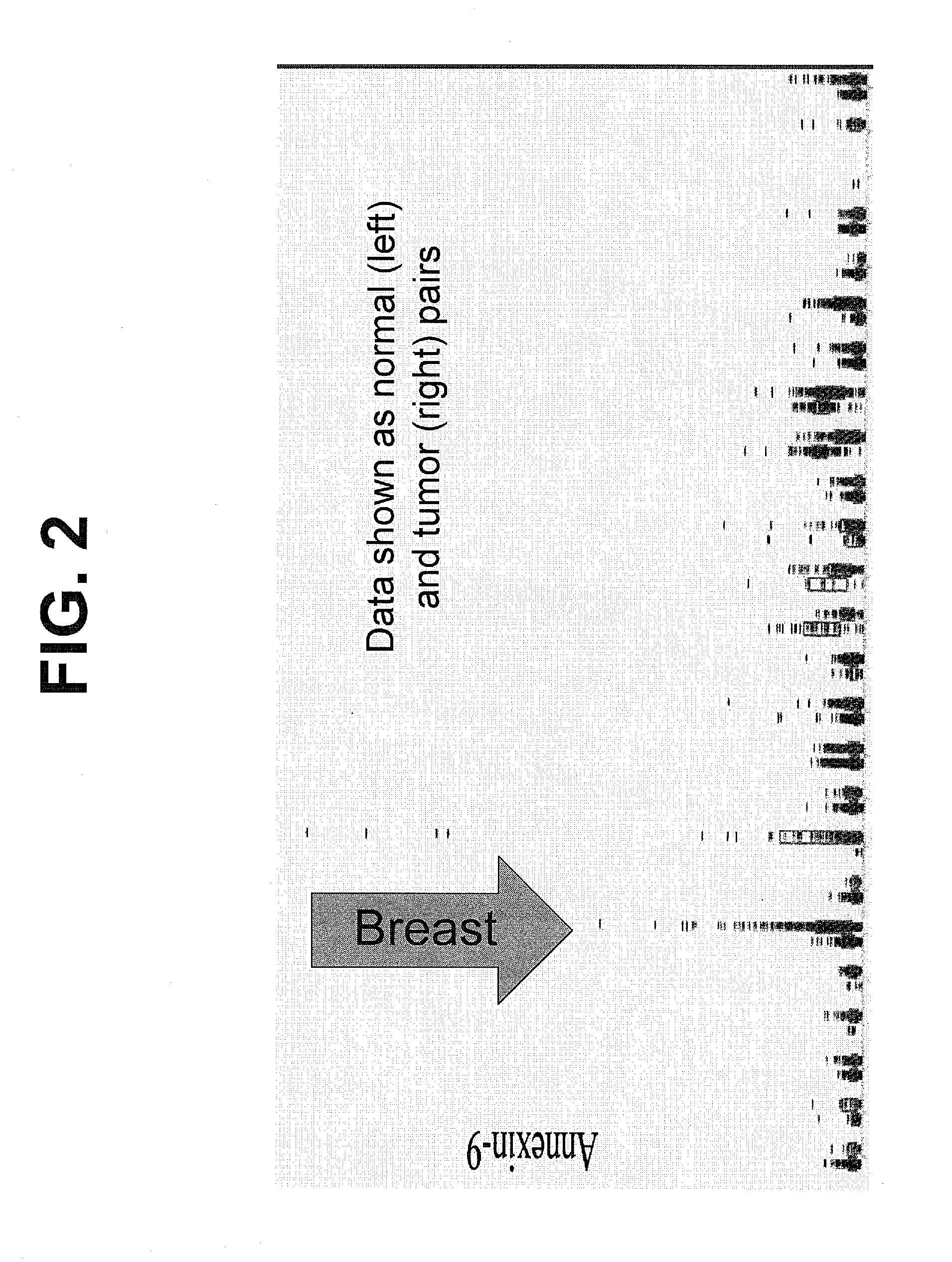 Annexin A9 (ANXA9) biomarker and therapeutic target in epithelial cancer