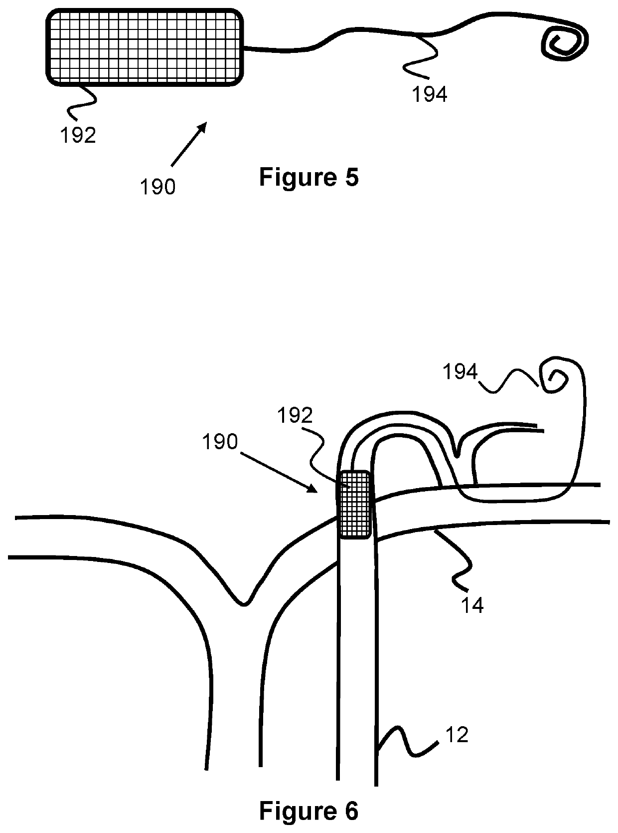 System And Method For Treatment Via Bodily Drainage Or Injection