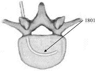 Device for forming cavity in centrum