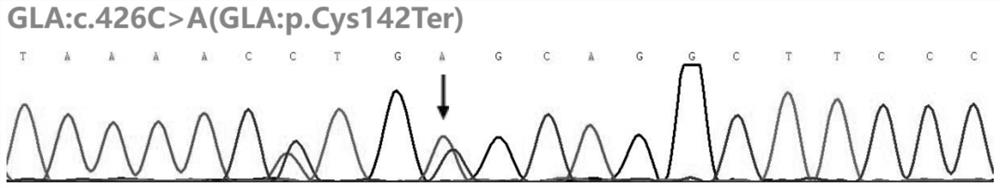 Rare genetic disease mutant gene and application thereof