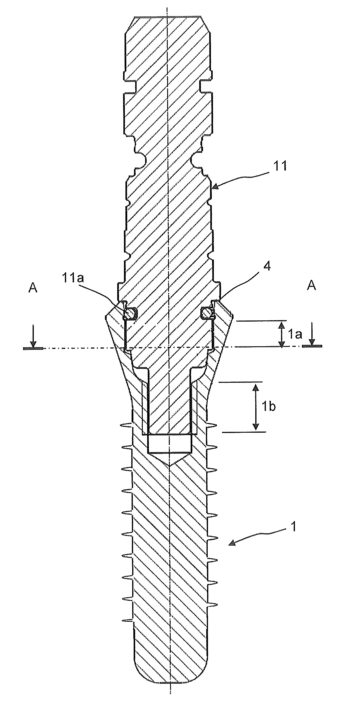 Dental implant socket arrangement