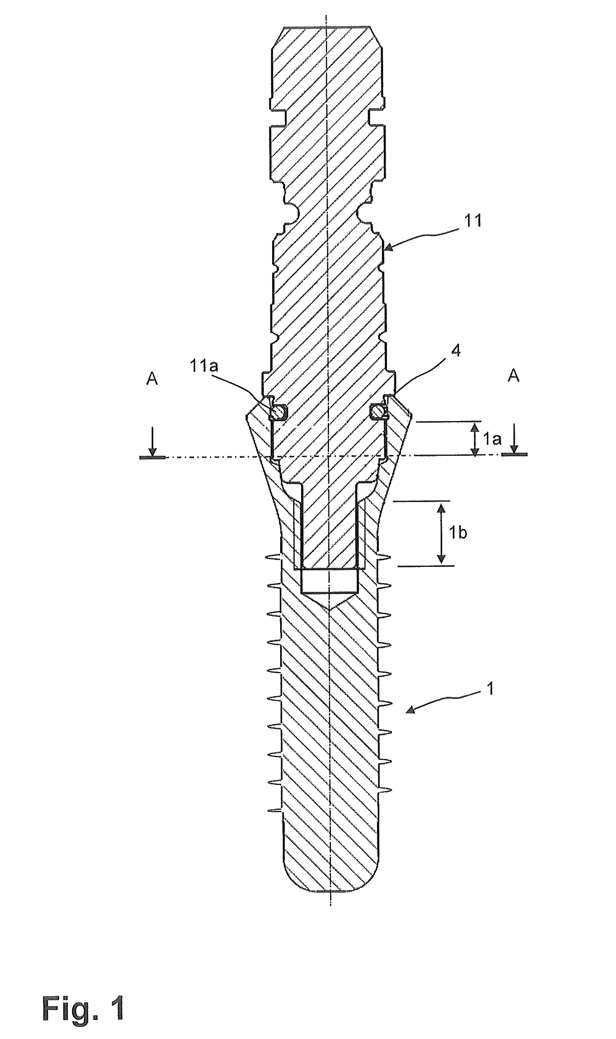 Dental implant socket arrangement