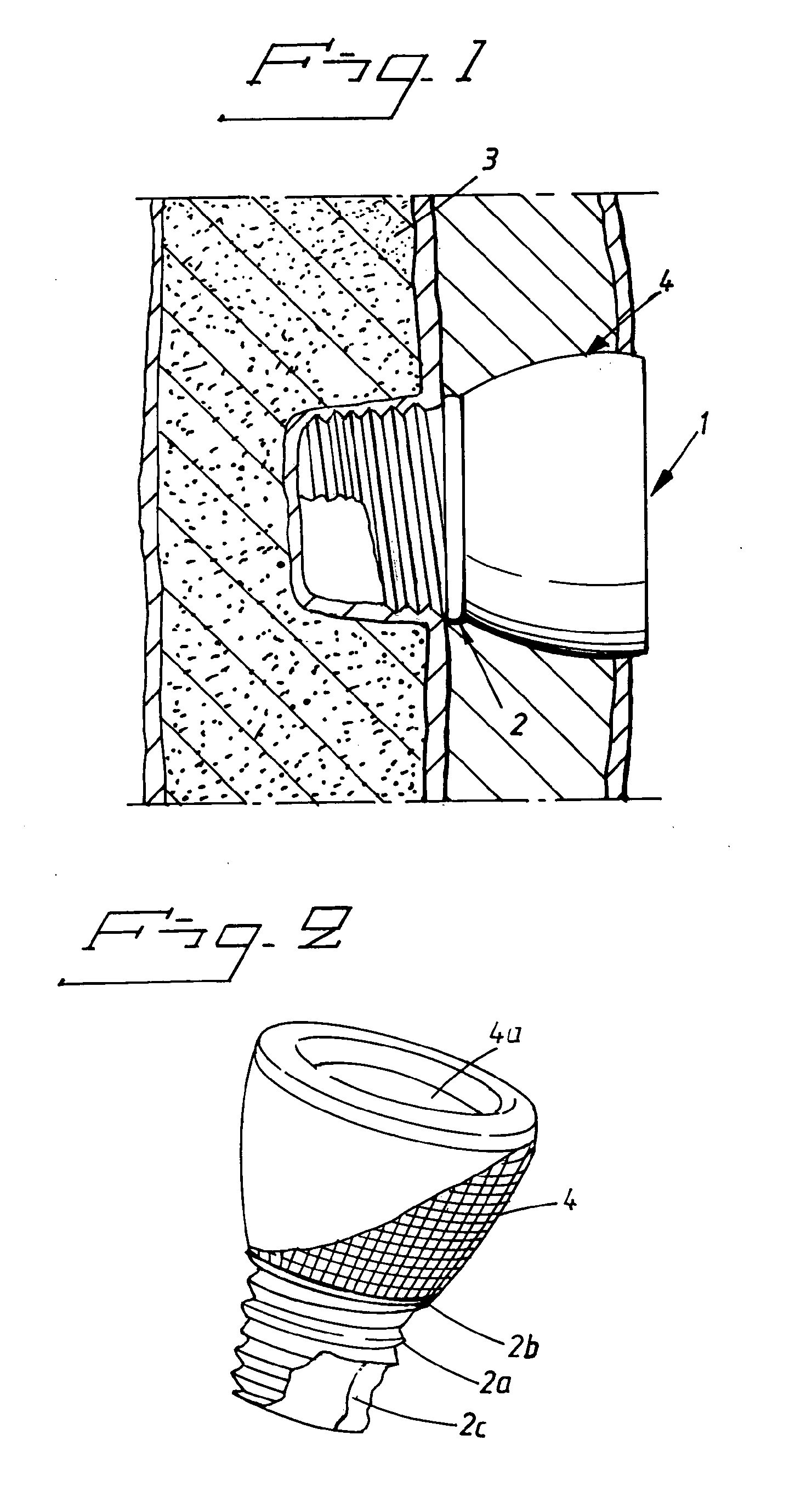 Implant abutment