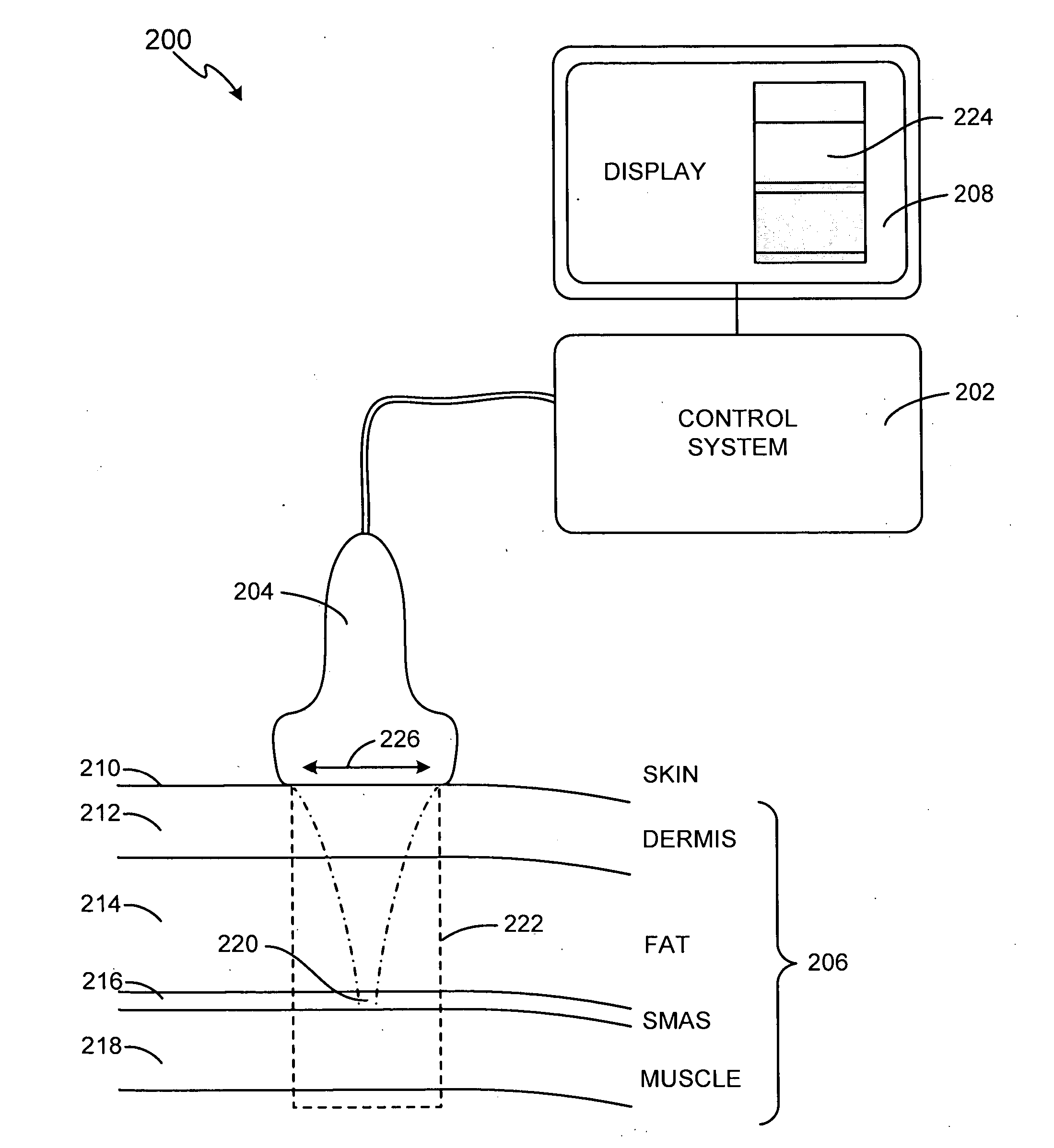 Method and system for noninvasive face lifts and deep tissue tightening