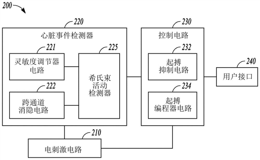 Adjustable sensing in a his-bundle pacemaker