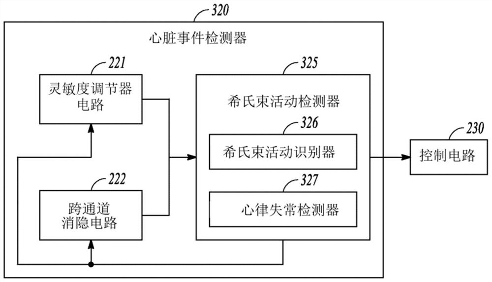 Adjustable sensing in a his-bundle pacemaker