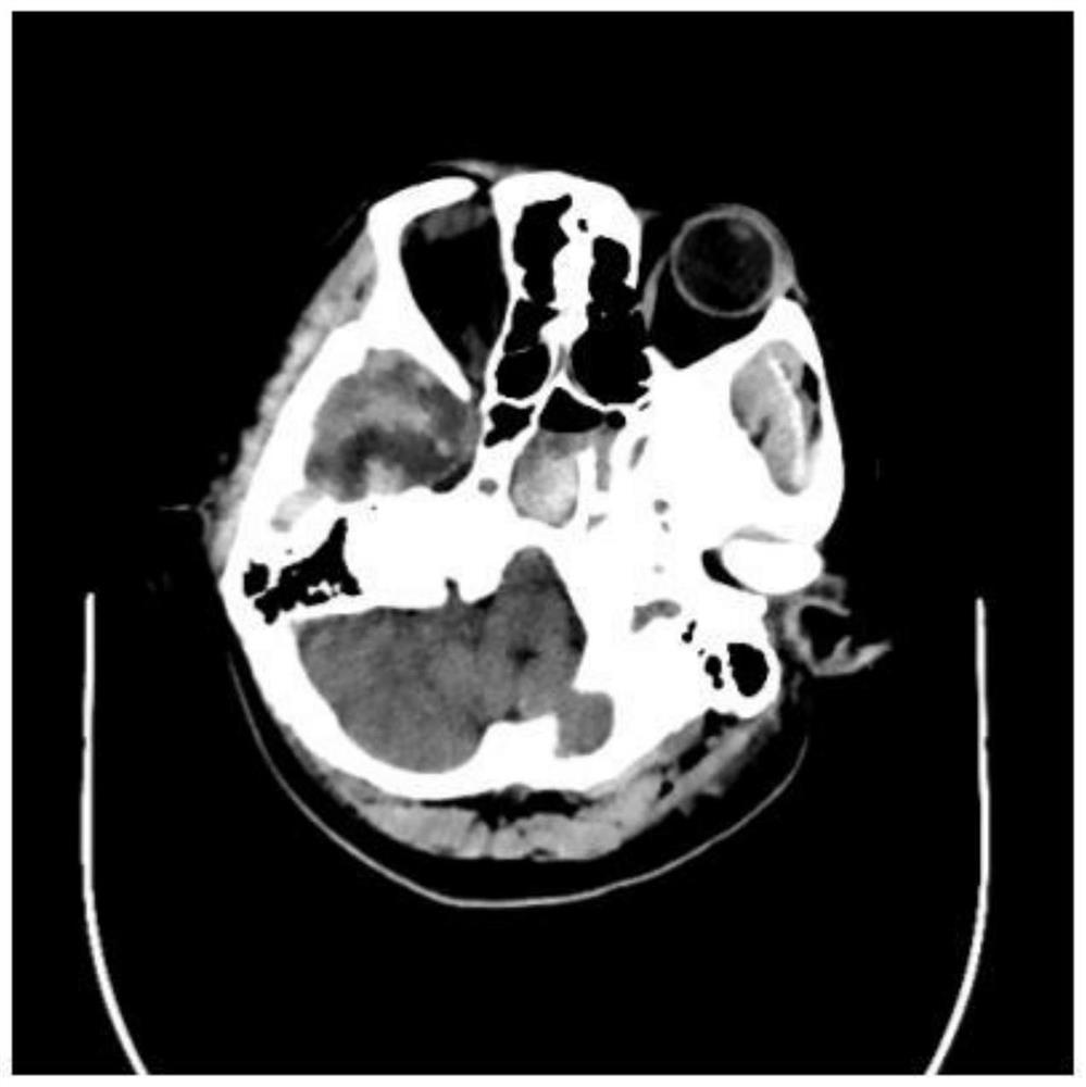 Intracranial hemorrhage automatic sketching method and device based on head CT (Computed Tomography) plain-scan image