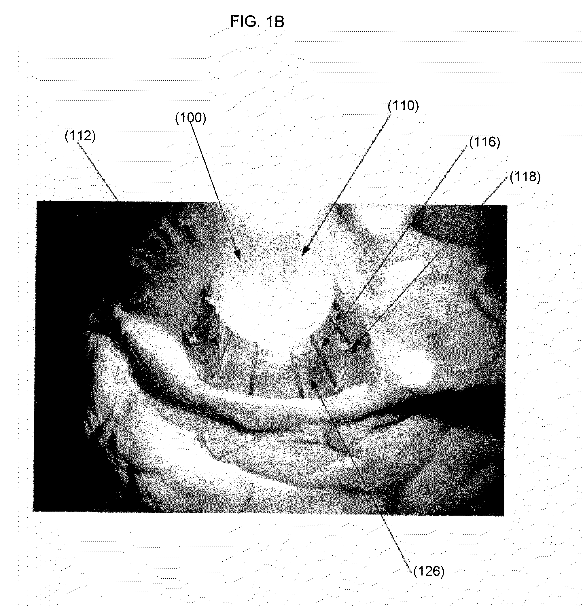 Inflatable minimally invasive system for delivering and securing an annular implant