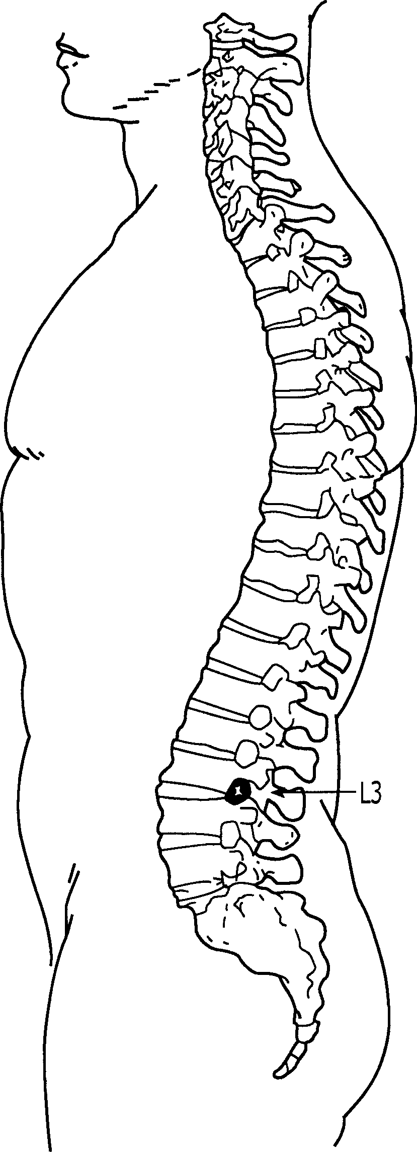 Subarachnoid epidural shunt