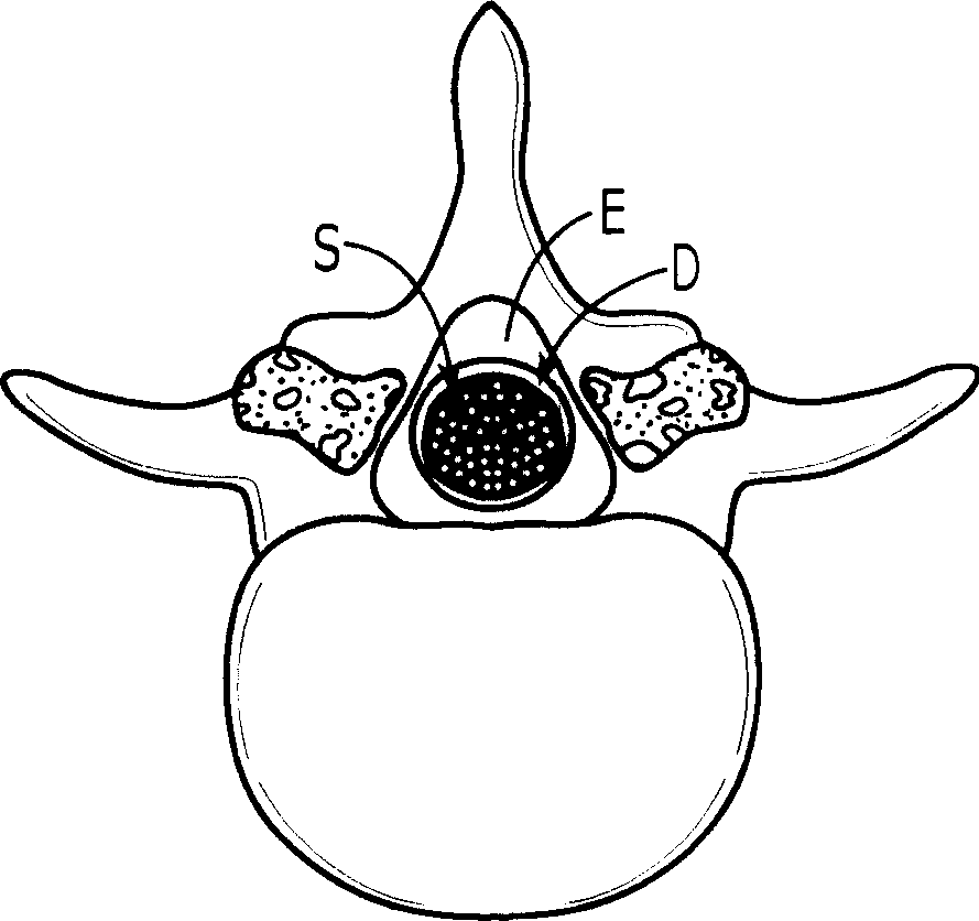 Subarachnoid epidural shunt