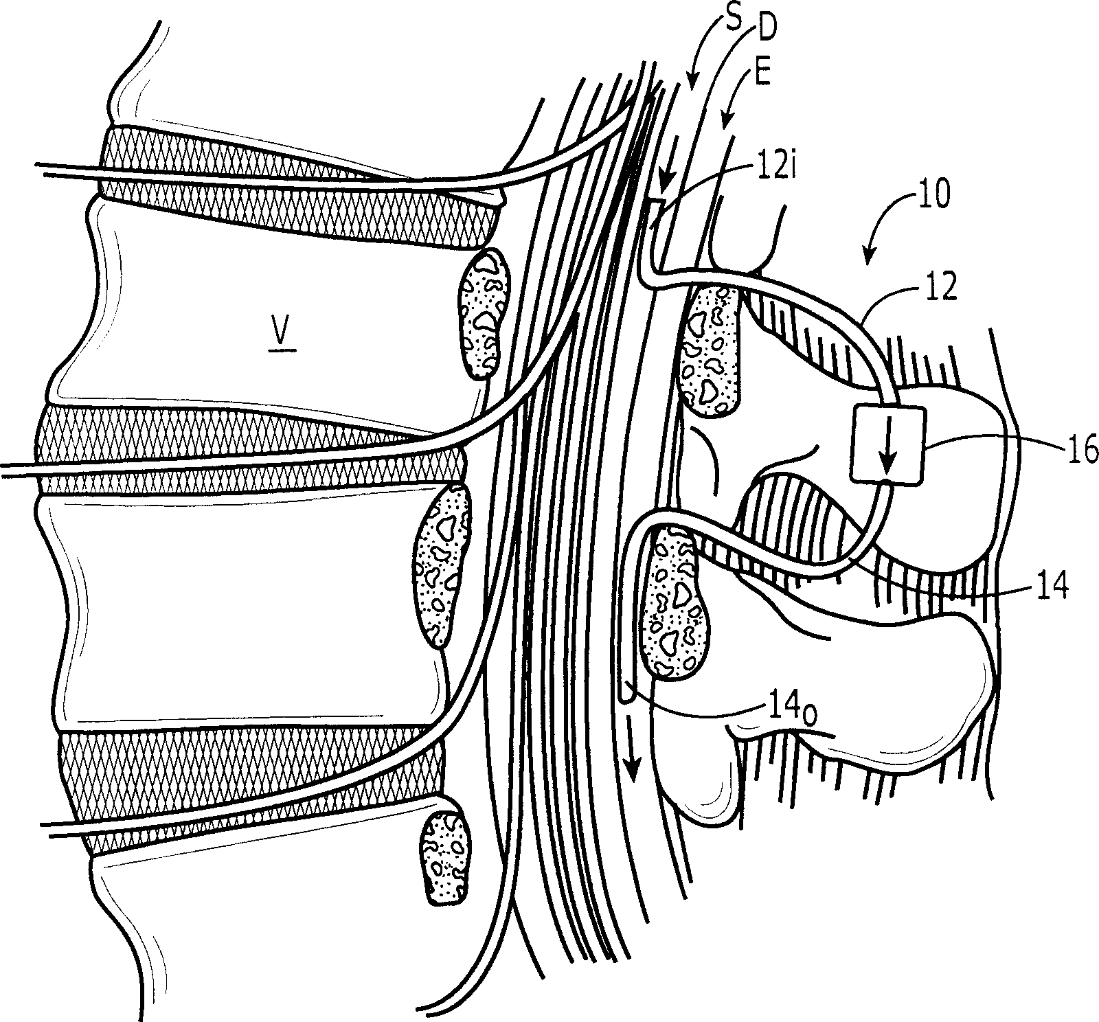 Subarachnoid epidural shunt