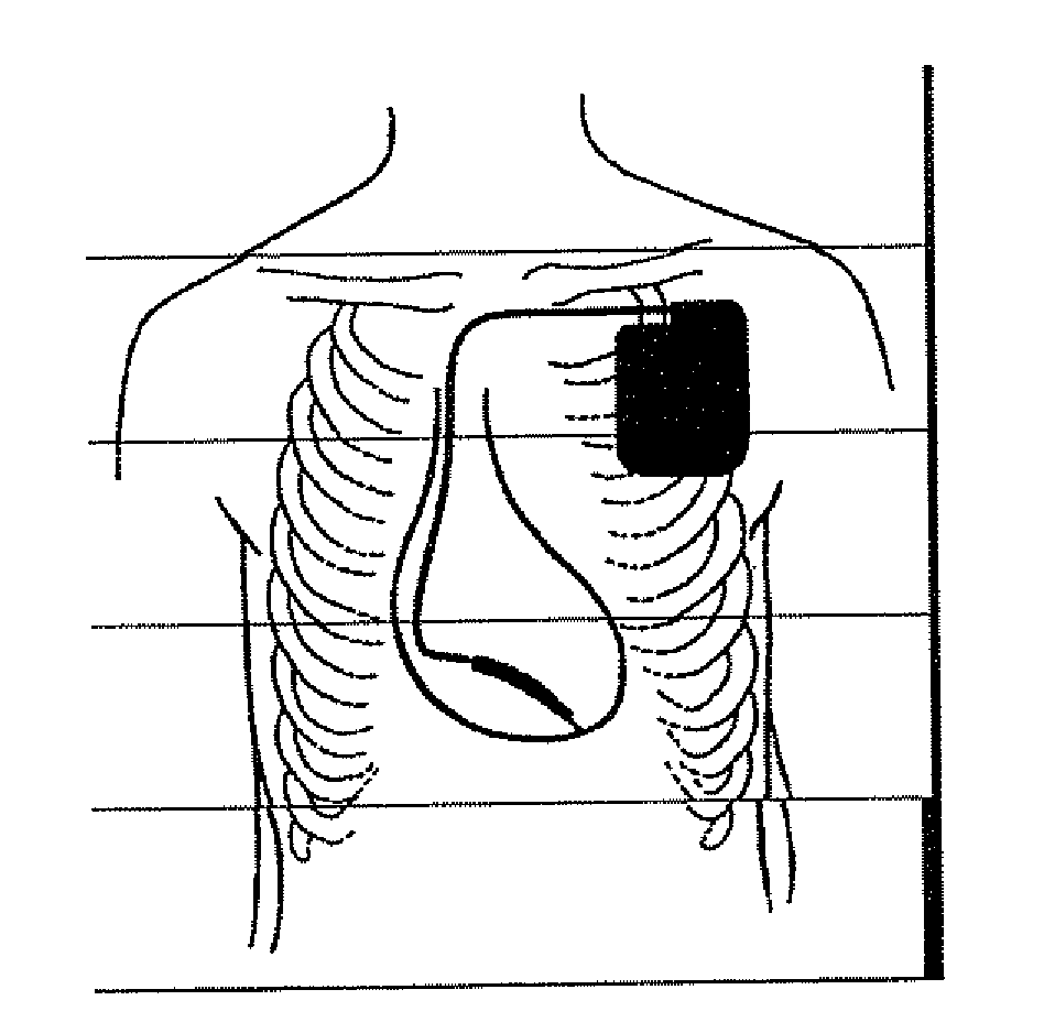 Method and apparatus for detection and treatment of autonomic system imbalance