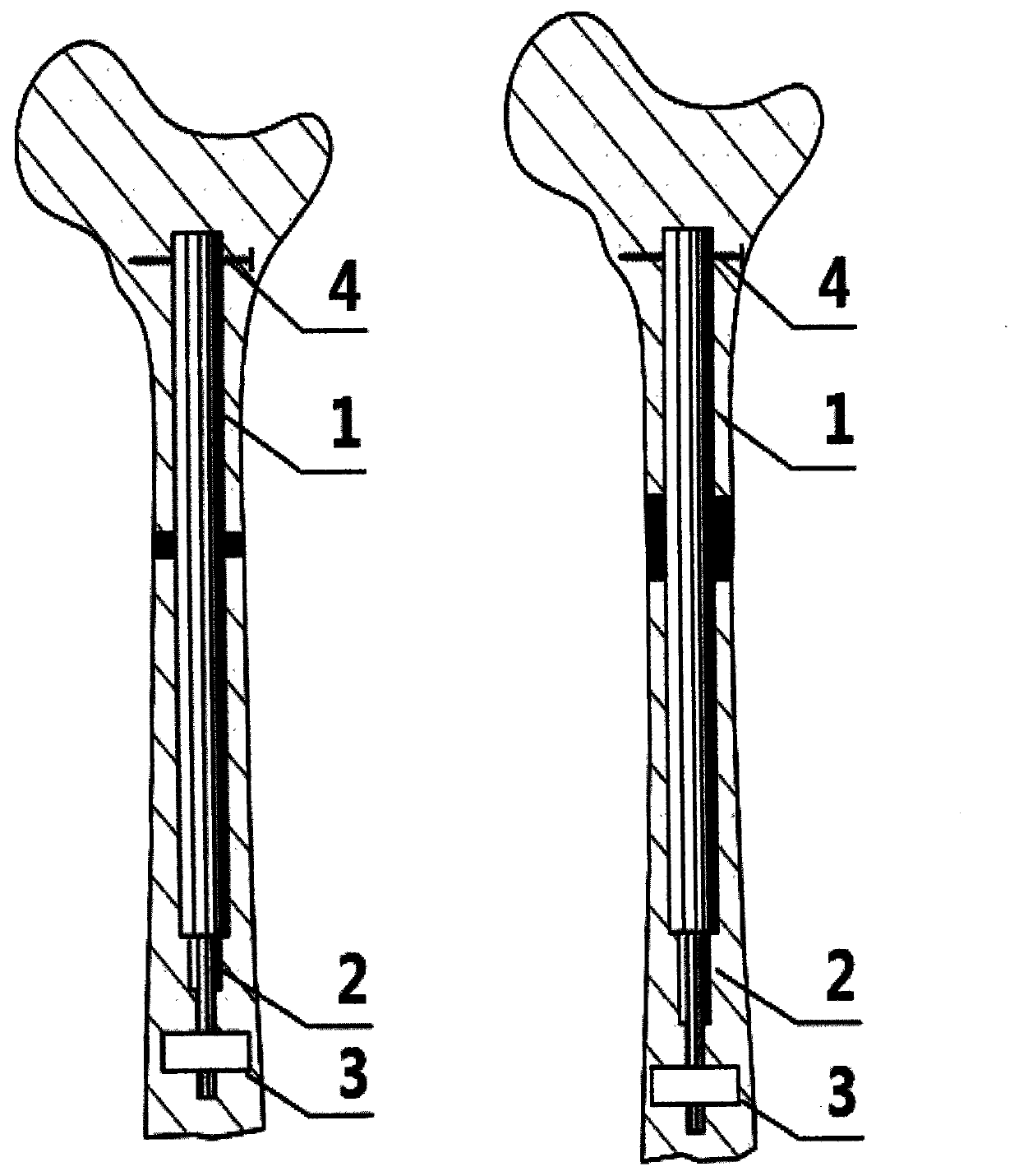 Intramedullary nail