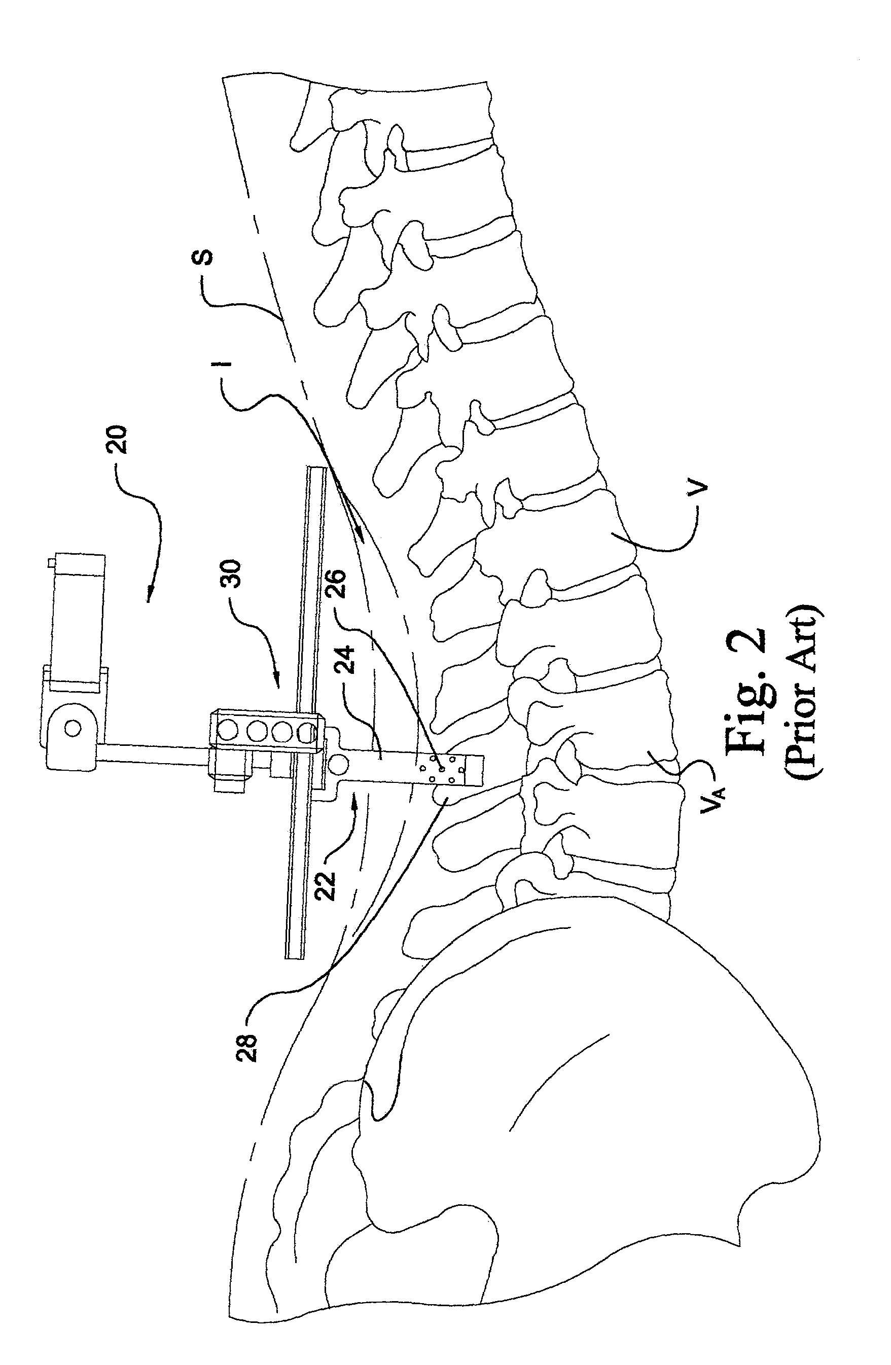 Instrumentation and method for mounting a surgical navigation reference device to a patient